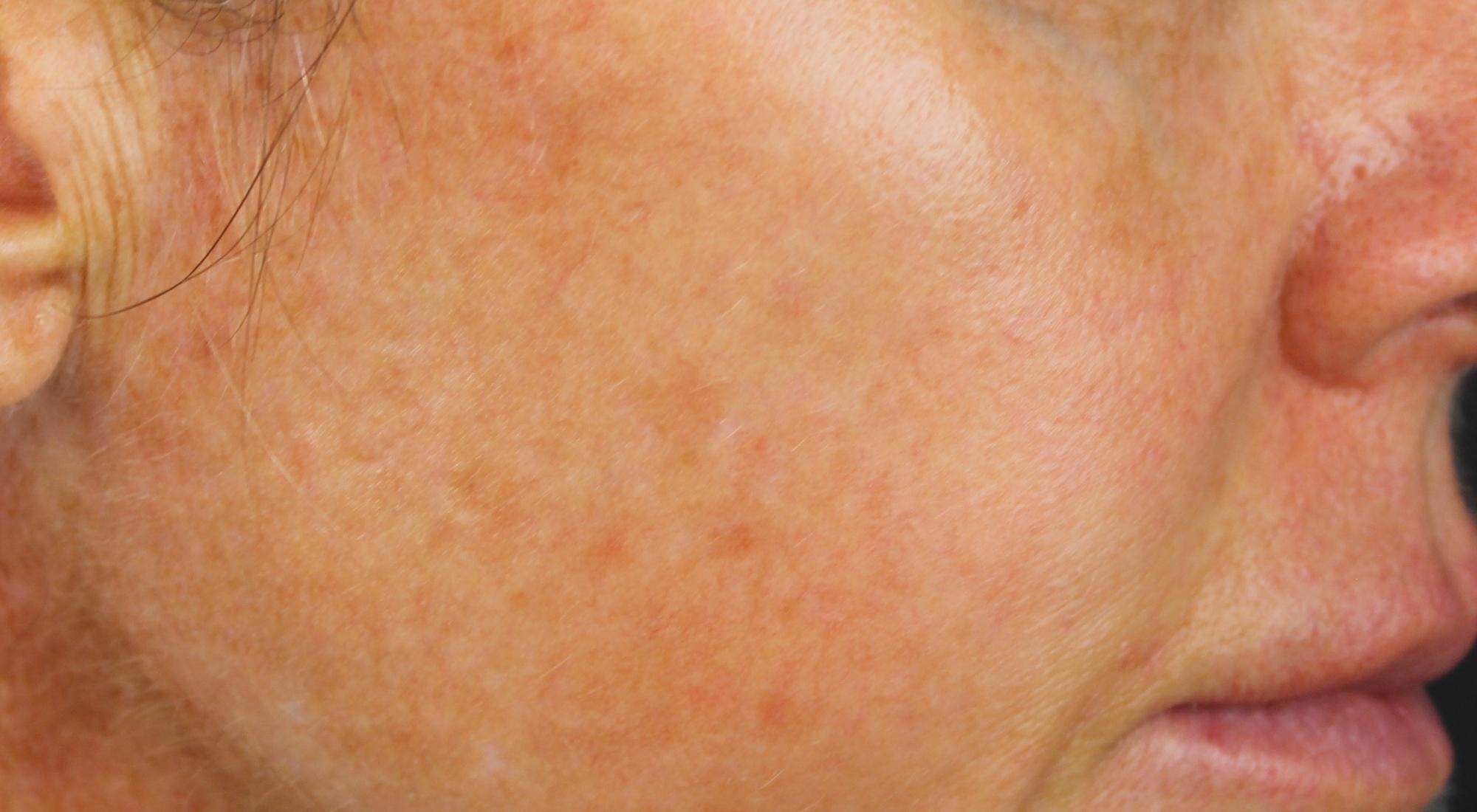 Before treatment for pigmentation The Australian sun damages skin over time but Dr Natasha Cook is a specialist who can identify treatment plans