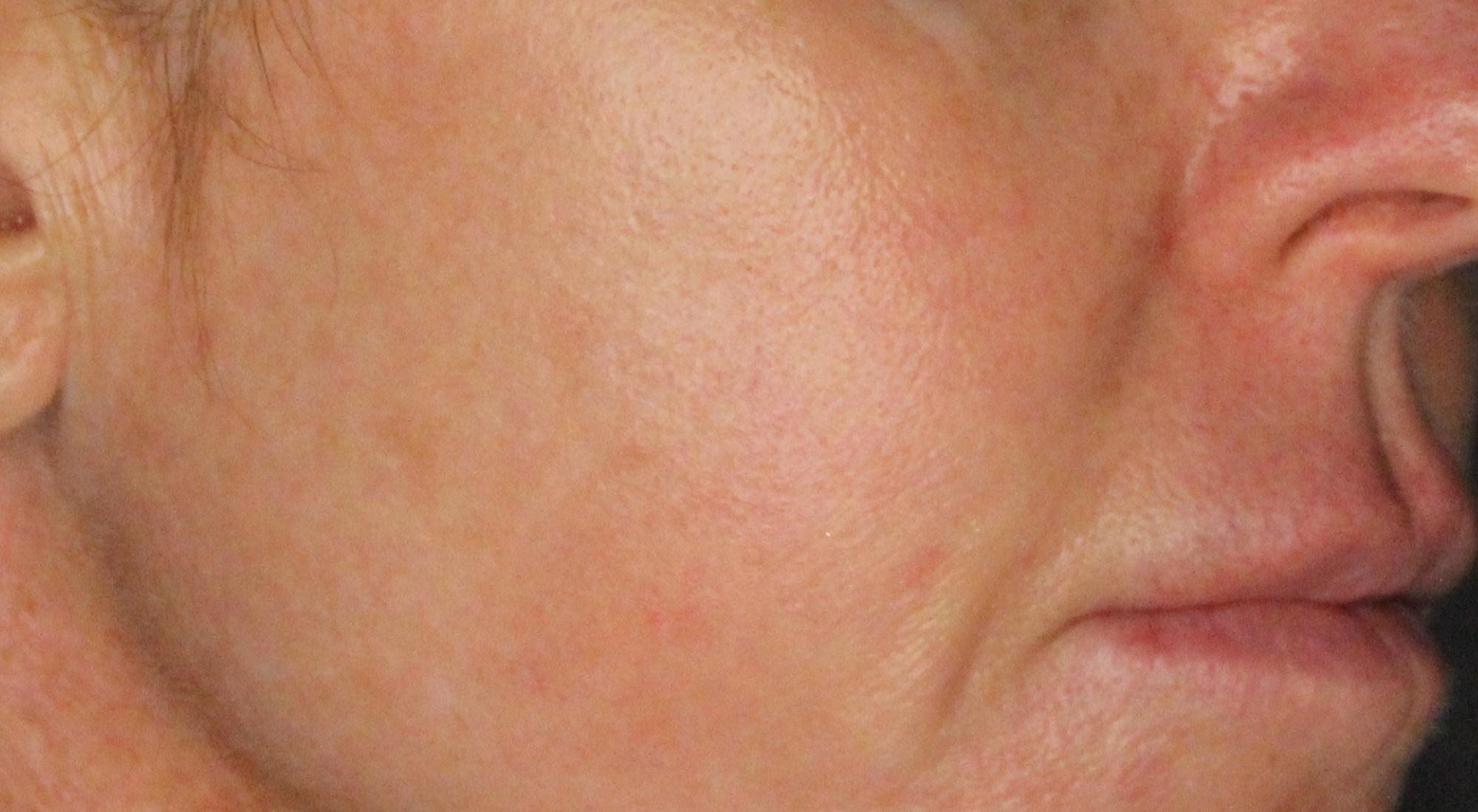 Dr Natasha Cook correctly diagnosed and identified a bespoke treatment plan for a woman, who now has even skin tone that's tighter and more youthful