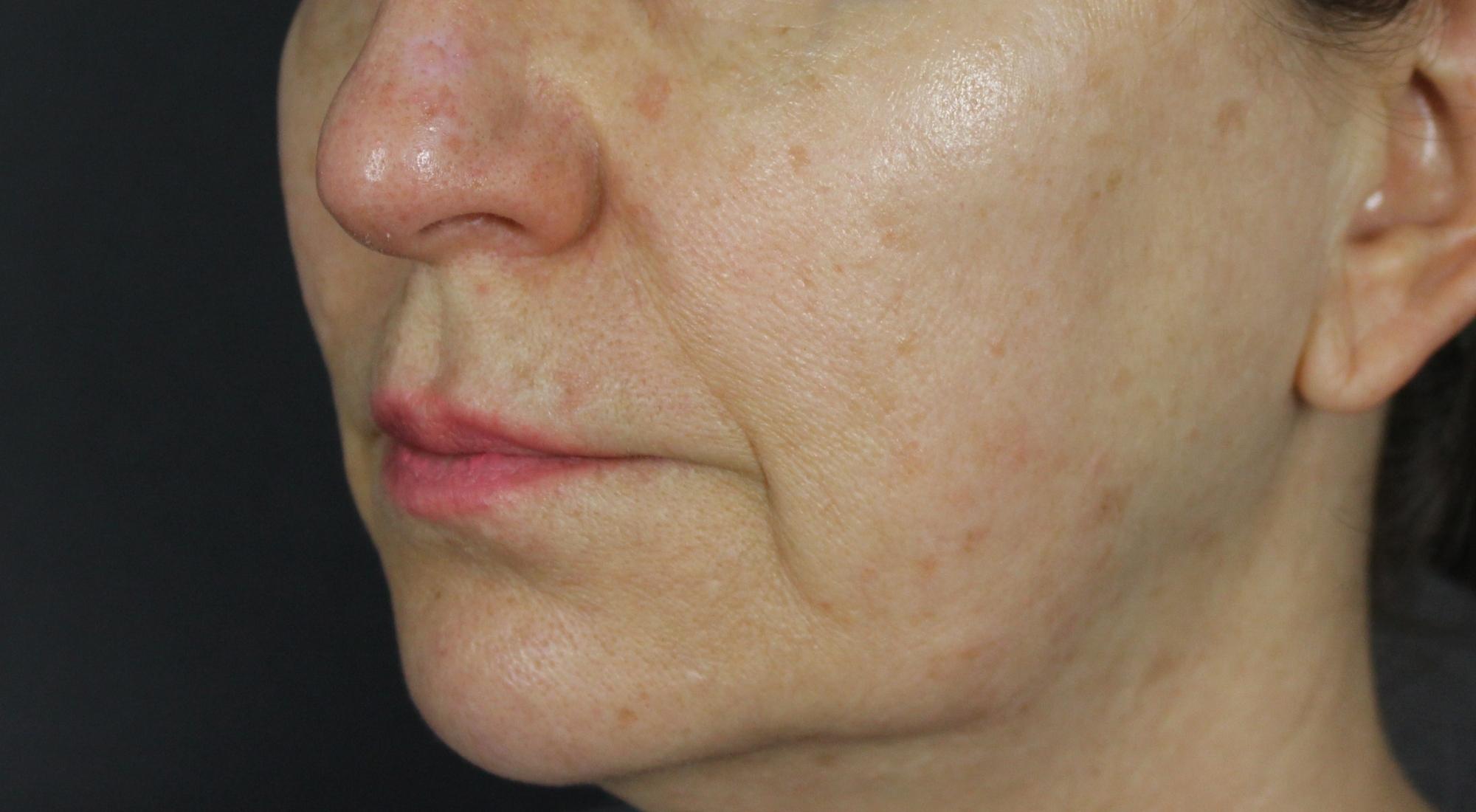 Before treatment with Dr Natasha Cook for skin laxity