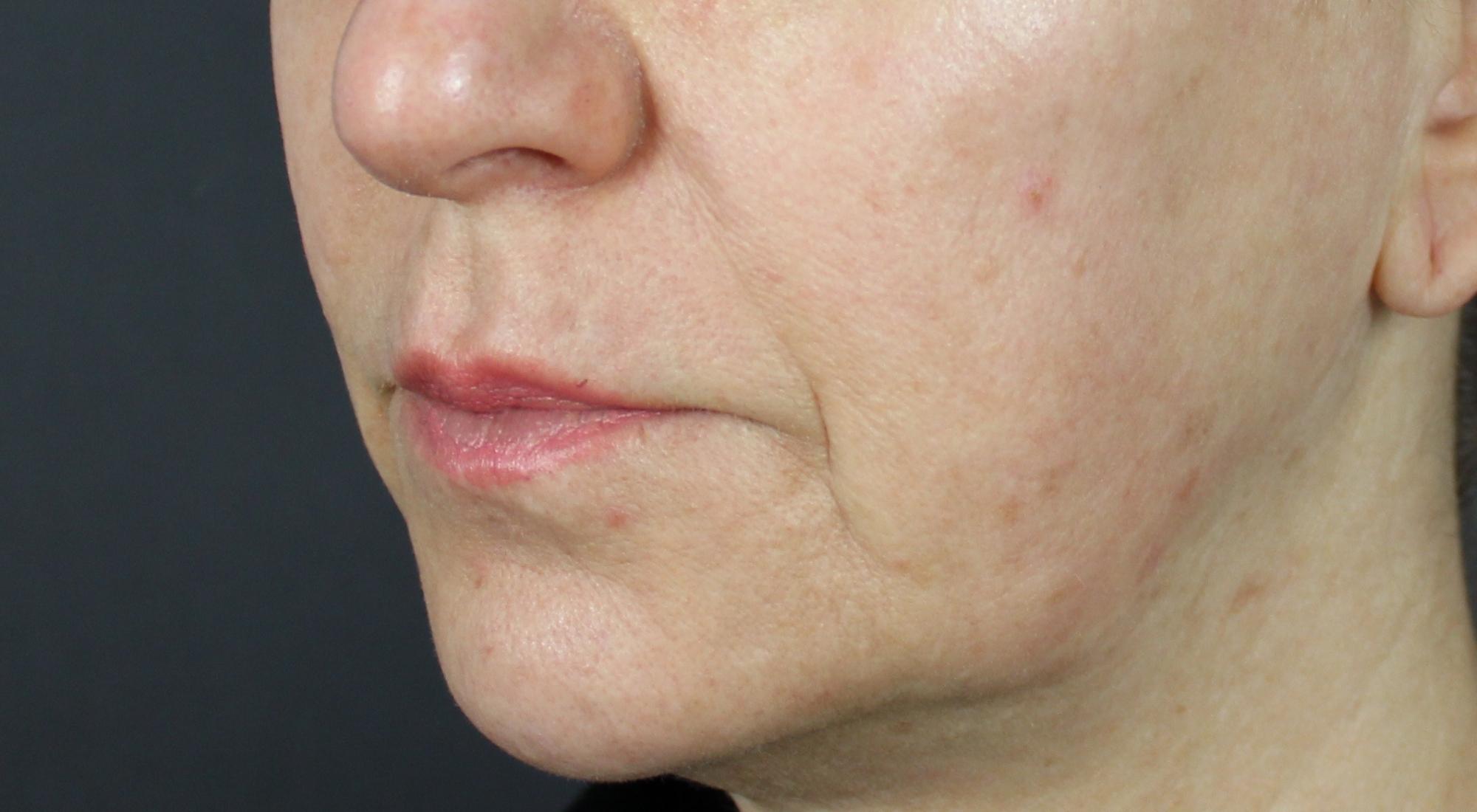 After Alma Hybrid treatment with Dr Natasha Cook