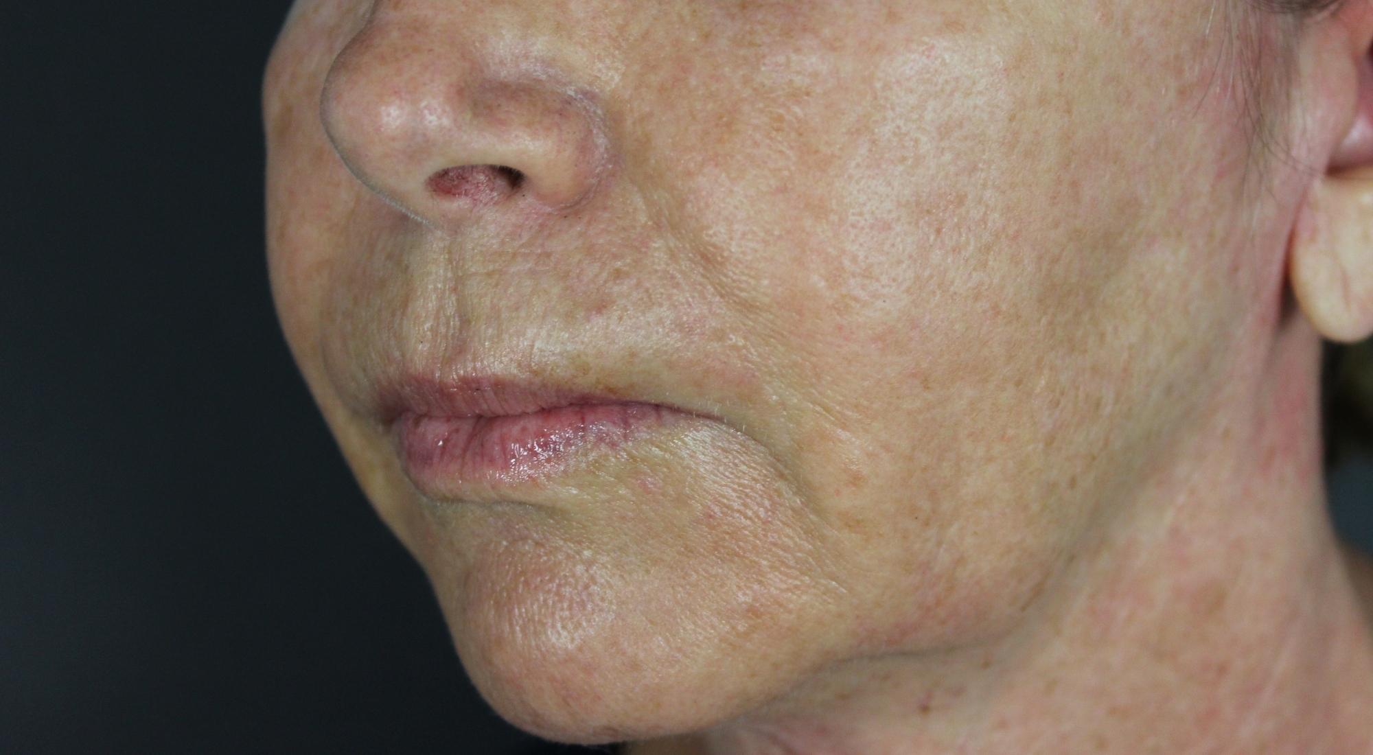 Before Alma hybrid treatment for sun damage and pigmentation the Alma Hybrid has a unique ability to treat a range of conditions, which were prescribed for this patient