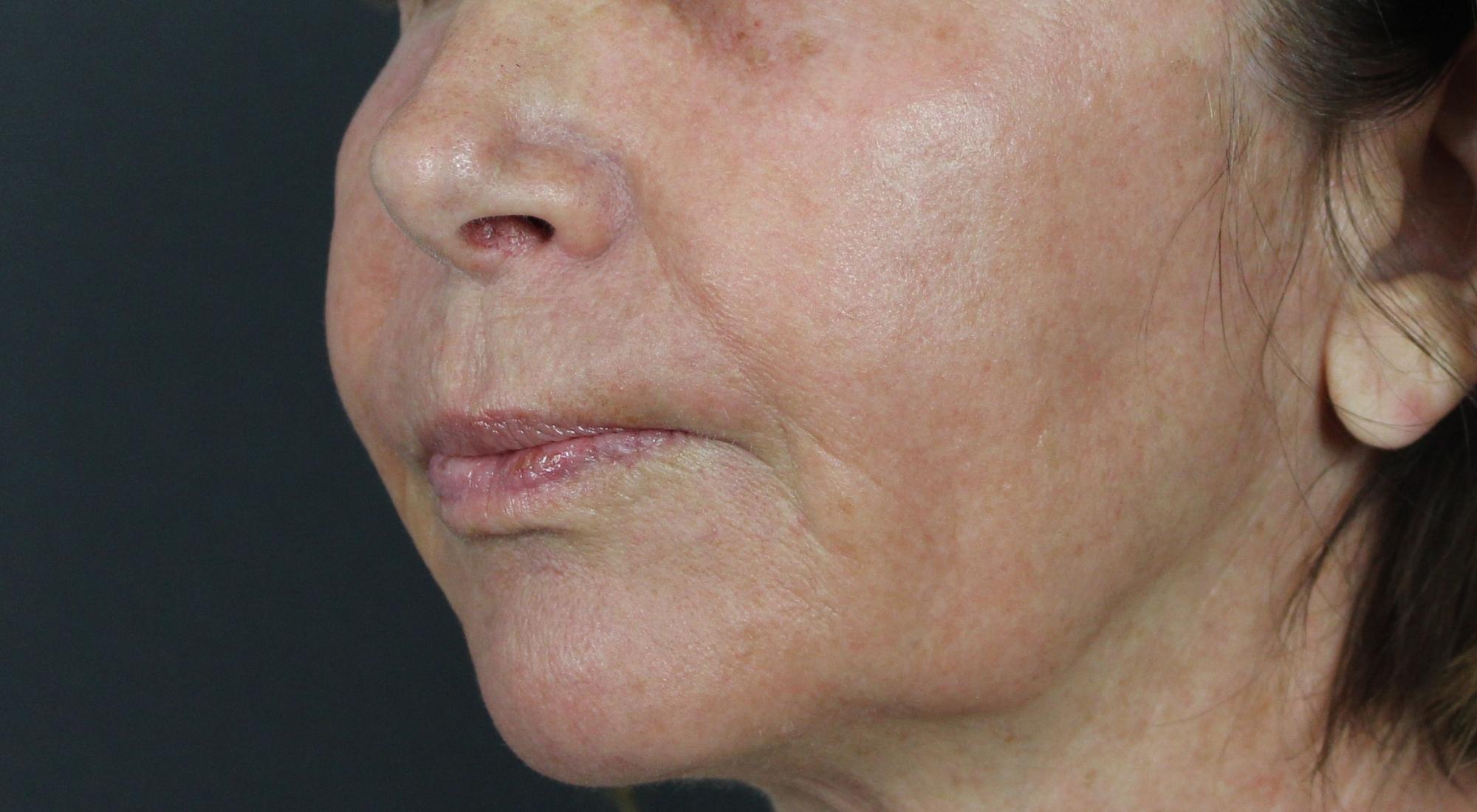 After Alma laser treatment