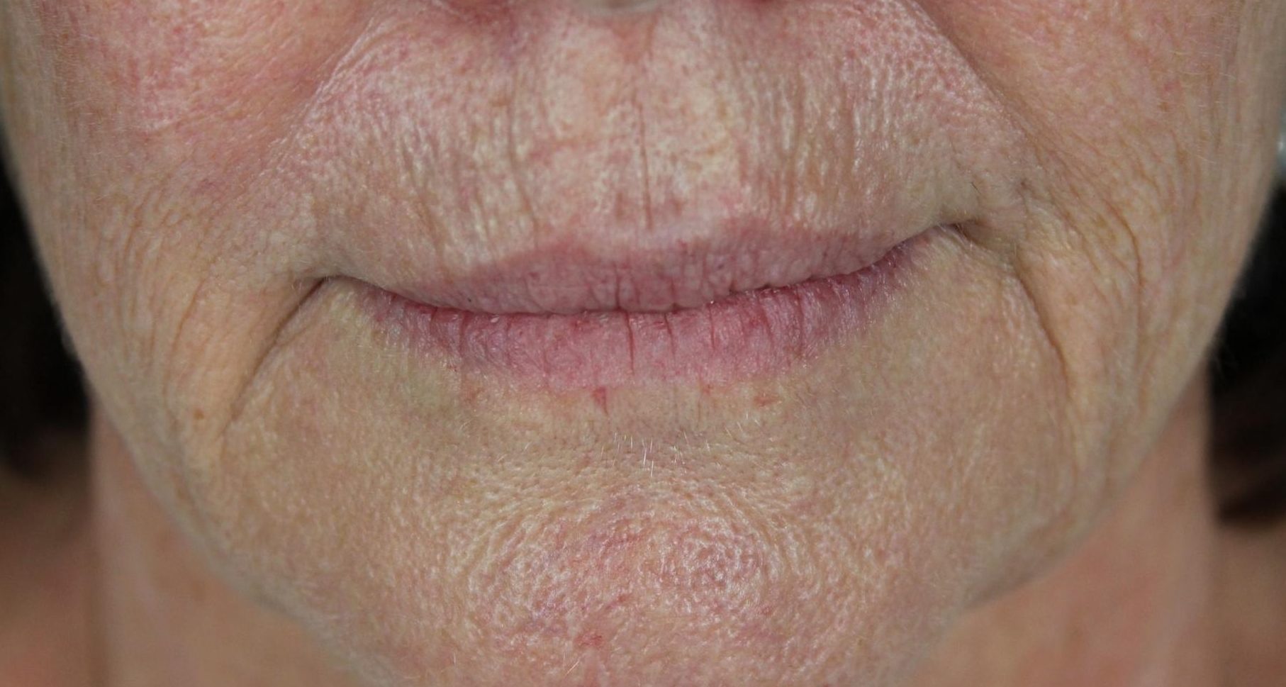 Before treatment perioral fine wrinkles, drooping lines at the side of the mouth and deeper naso-labial folds are evident