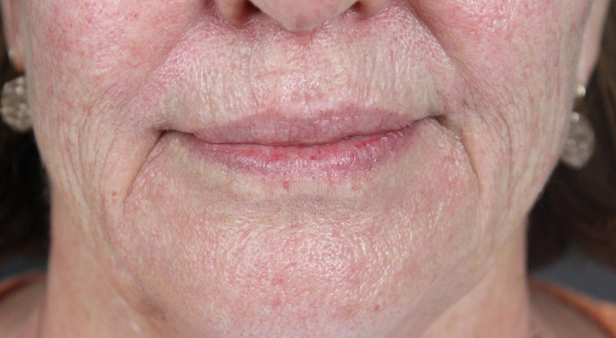 After Alma CO2 laser for perioral skin ageing