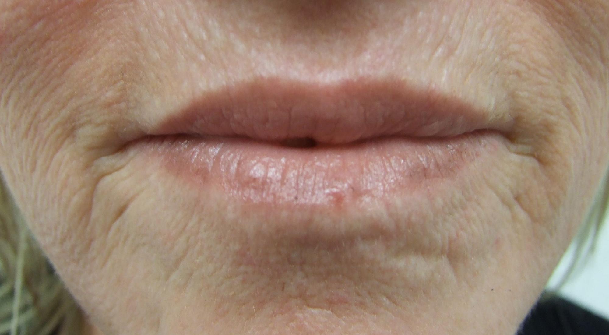 Perioral Profractional Laser Treatment Before