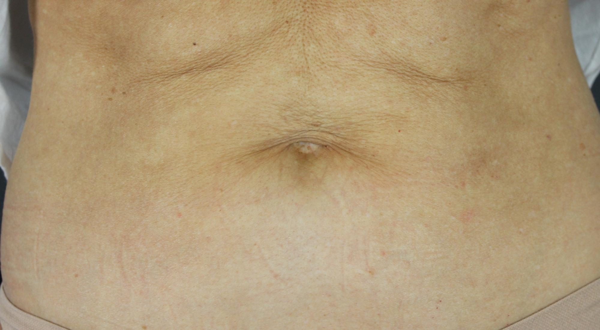 Before treatment a sagging stomach prevented this woman wearing a bikini