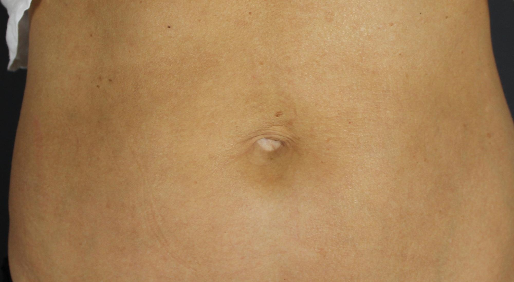 After treatment to sagging stomach with radio frequency Morpheus8 Kim Kardashian non-surgical tummy-tuck