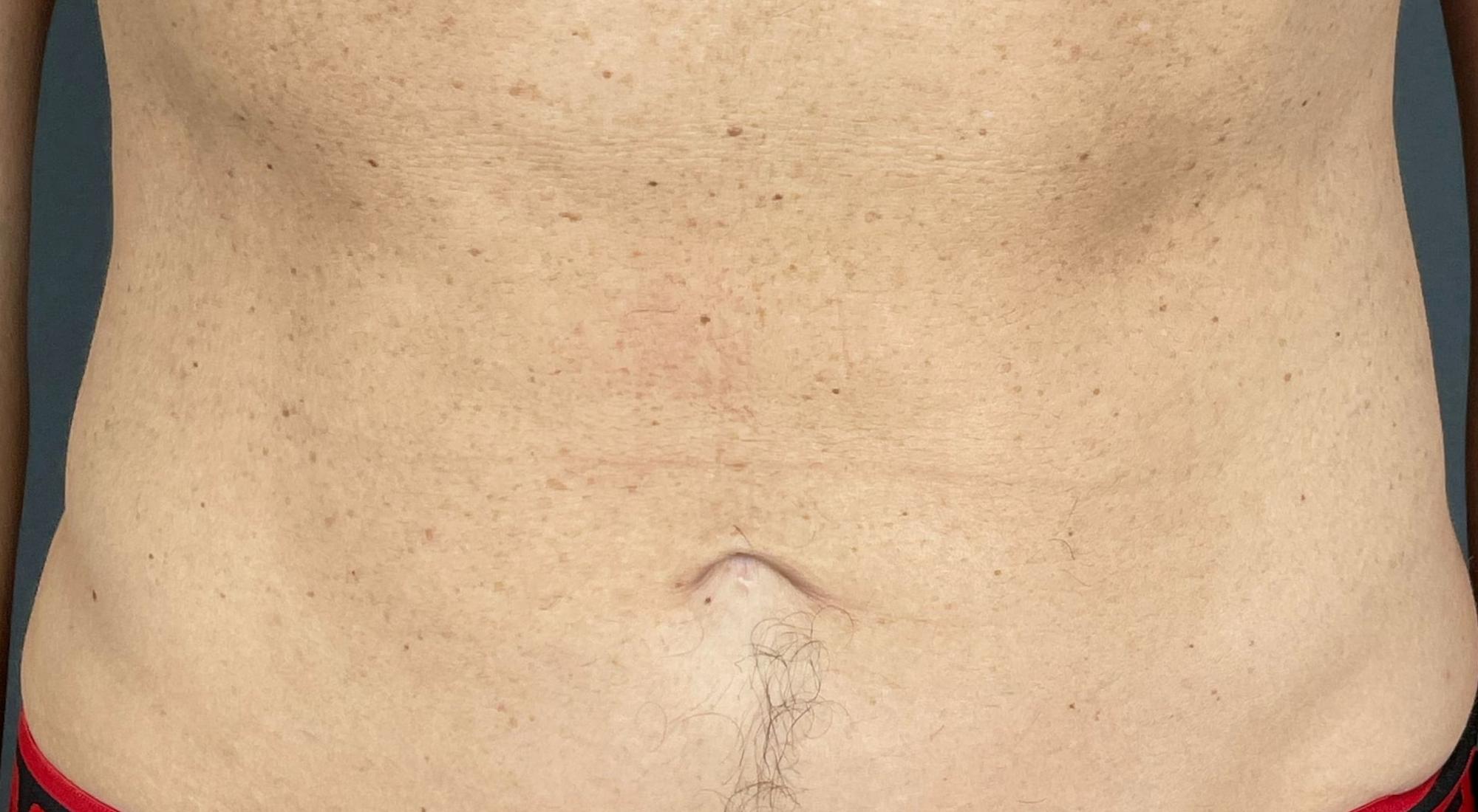Before Morpheus8 readiofrequency treatment to abdomen