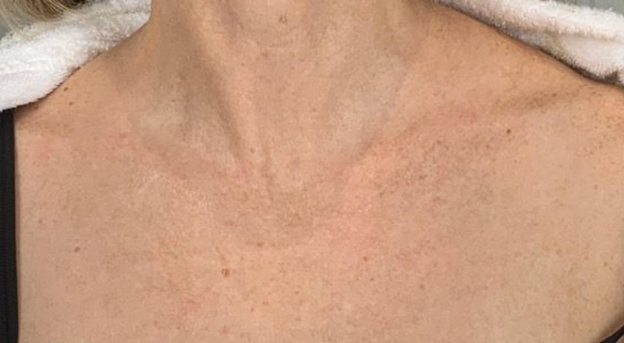 After treatment for pigmentation to chest