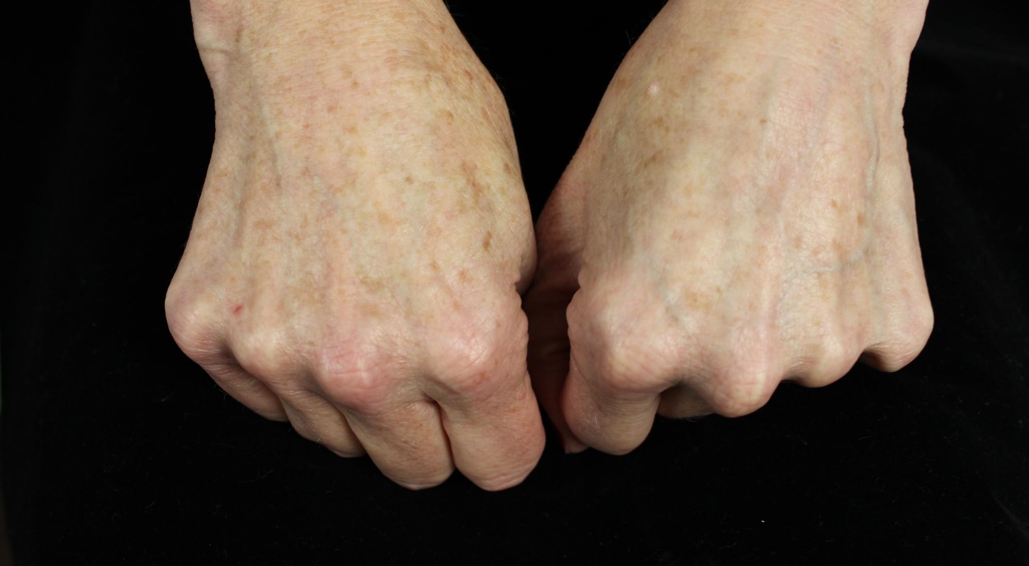 Hands of a female with sun spots and pigmentation