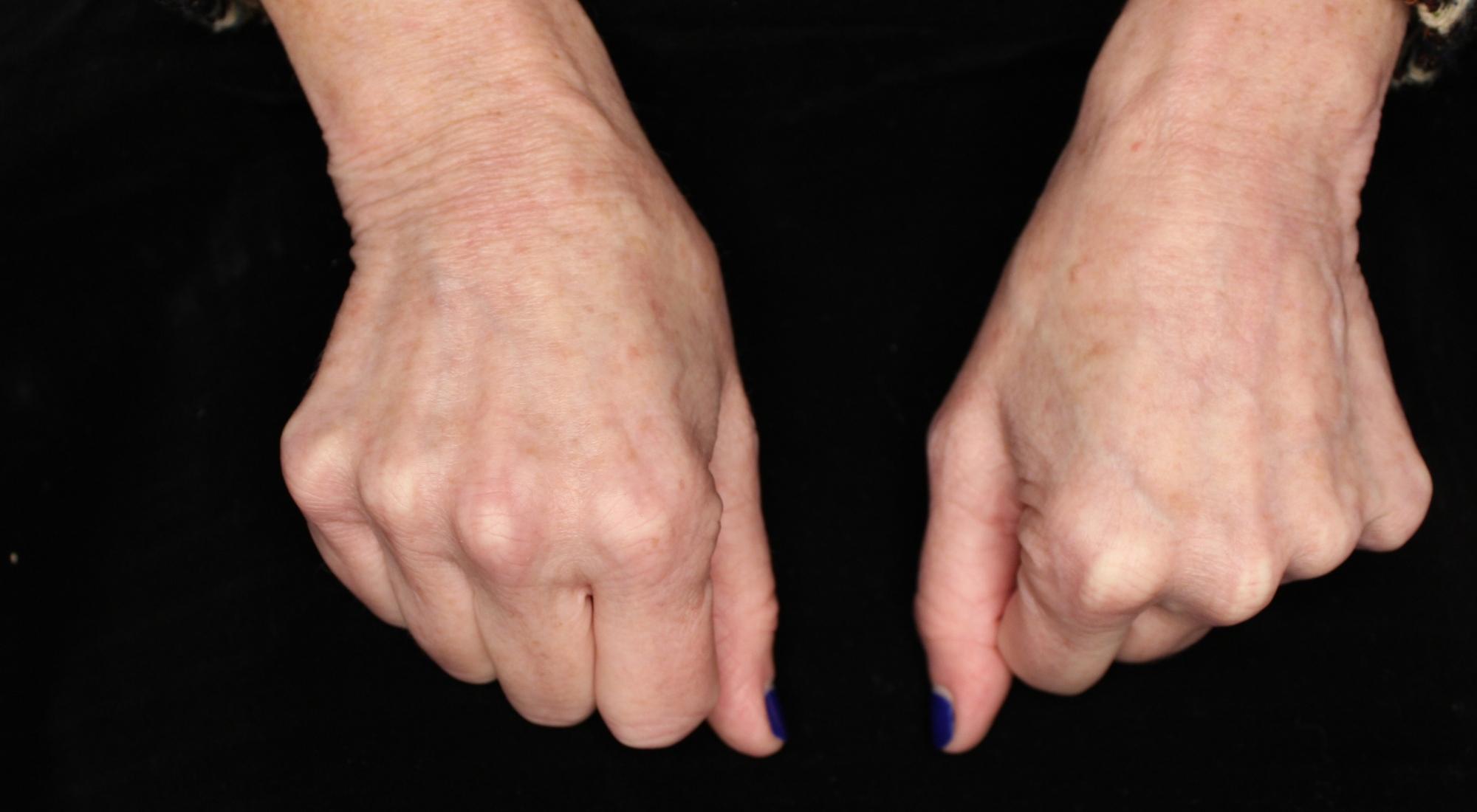 Post treatment, the hands are significantly rejuvenated, more youthful and the skin tone is more even