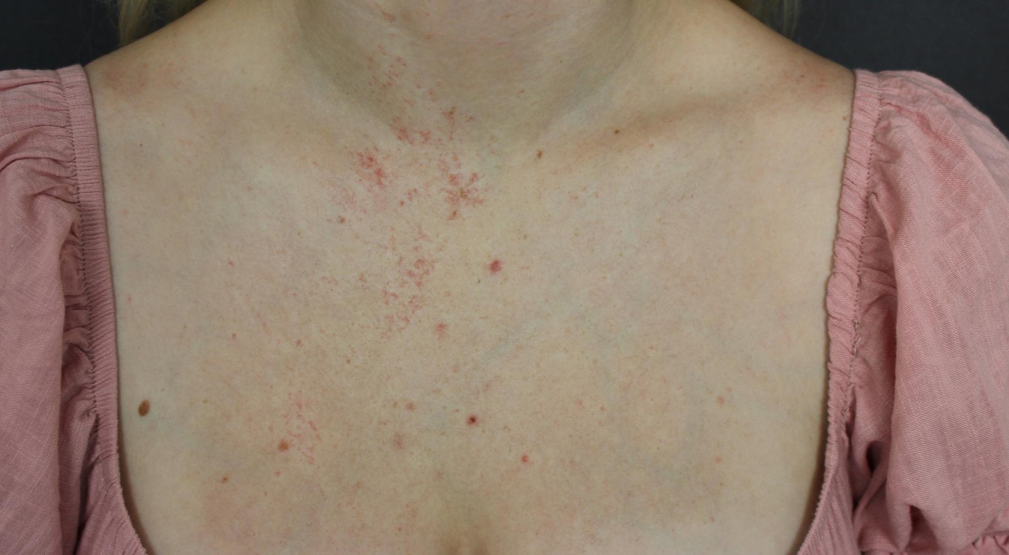 Before Cutera vascular treatment for birthmark on chest
