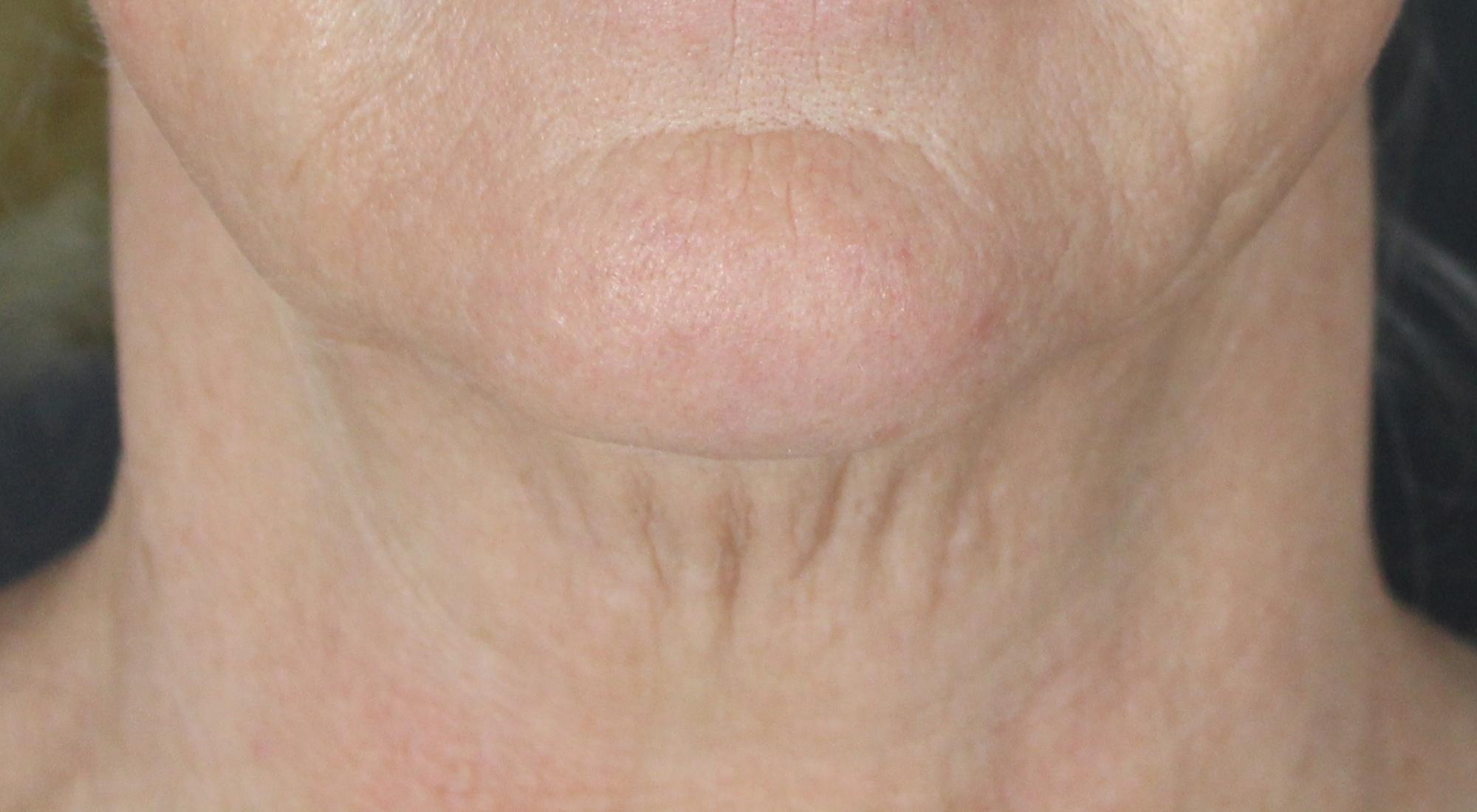 Before Morpheus8 to neck for skin laxity and tightening