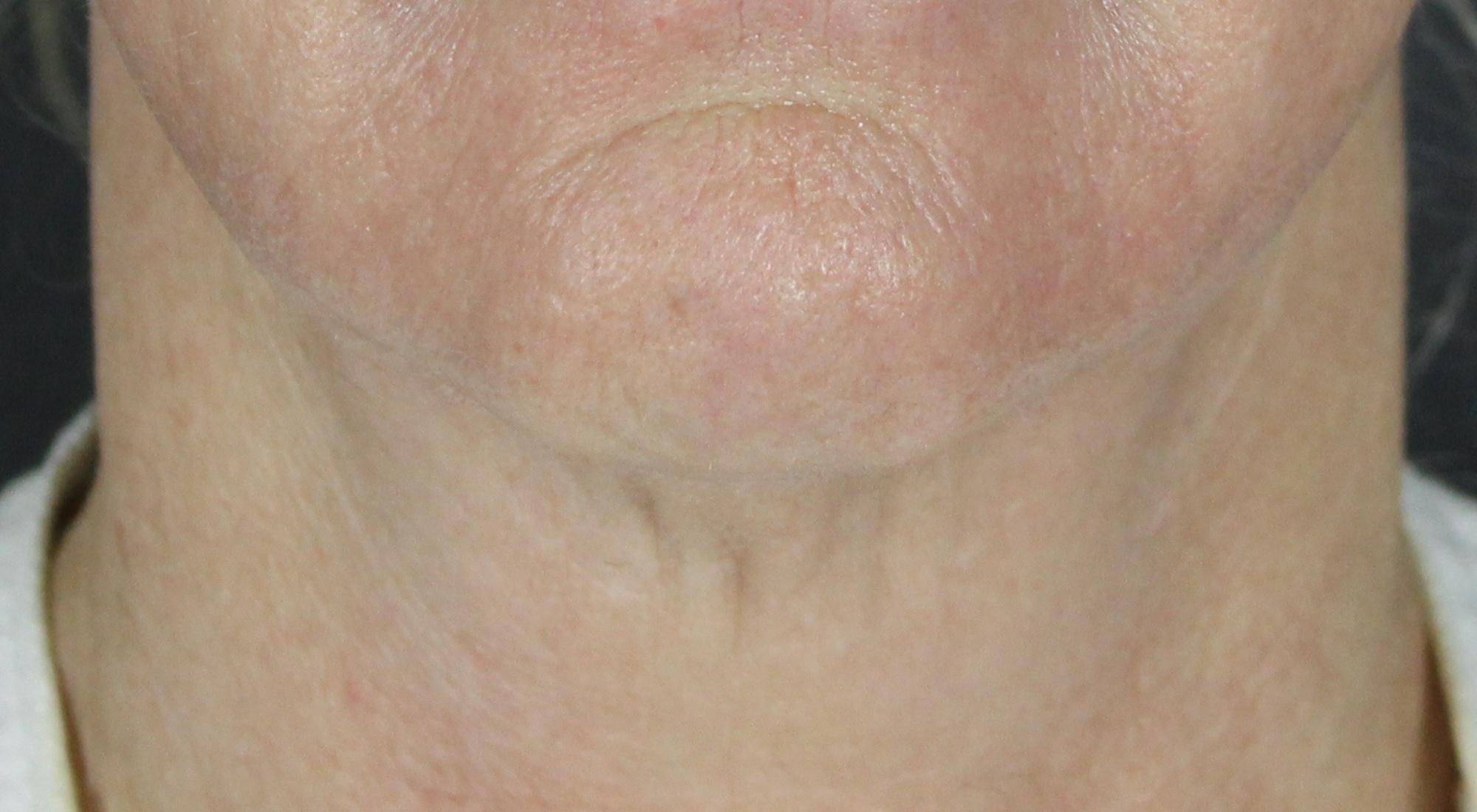 After Morpheus8 to neck for skin laxity and tightening