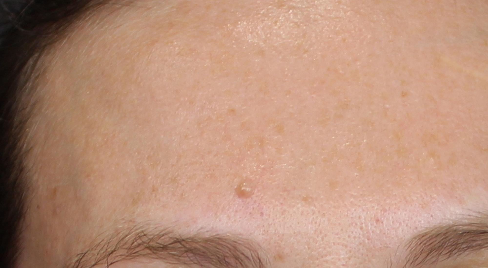 Before the lesion is significantly reduced and barely visible after dermatology treatment