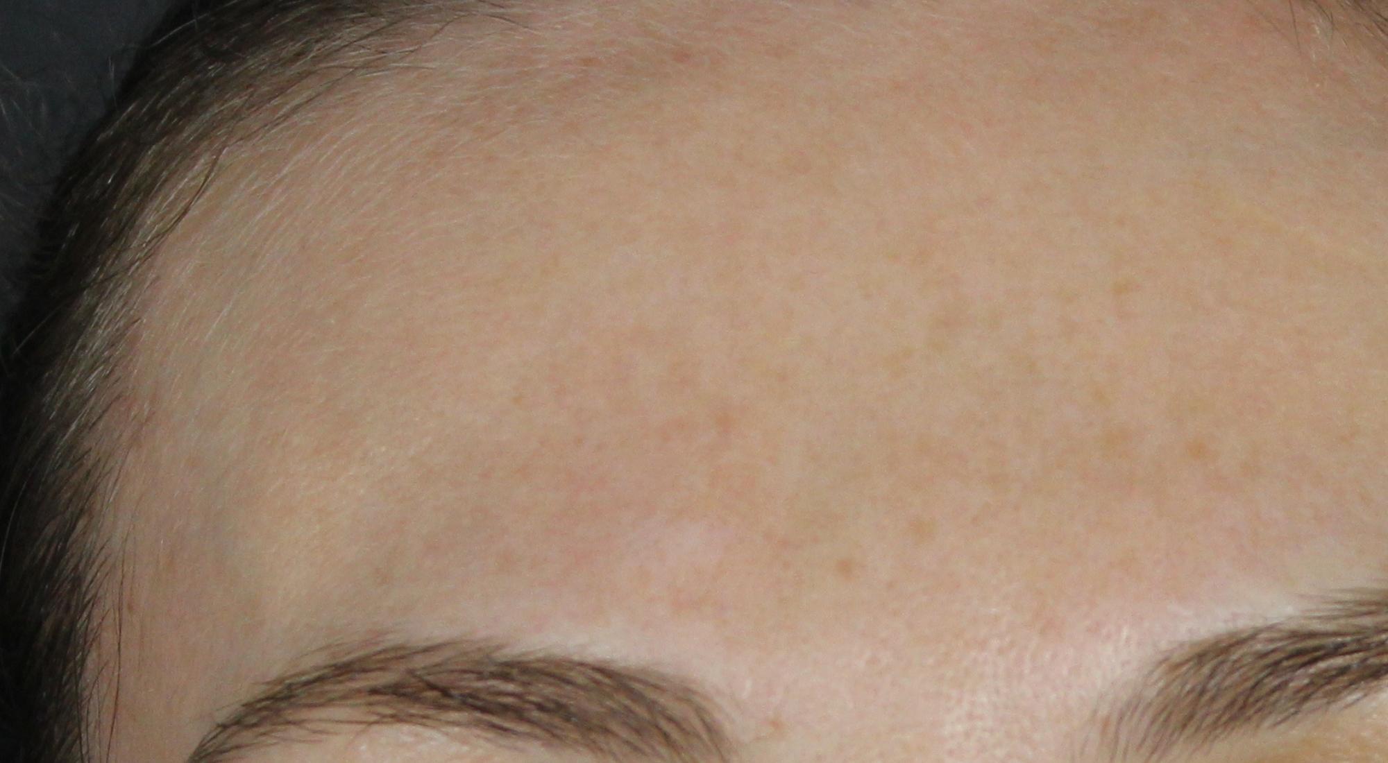 The lesion is significantly reduced and barely visible after dermatology treatment