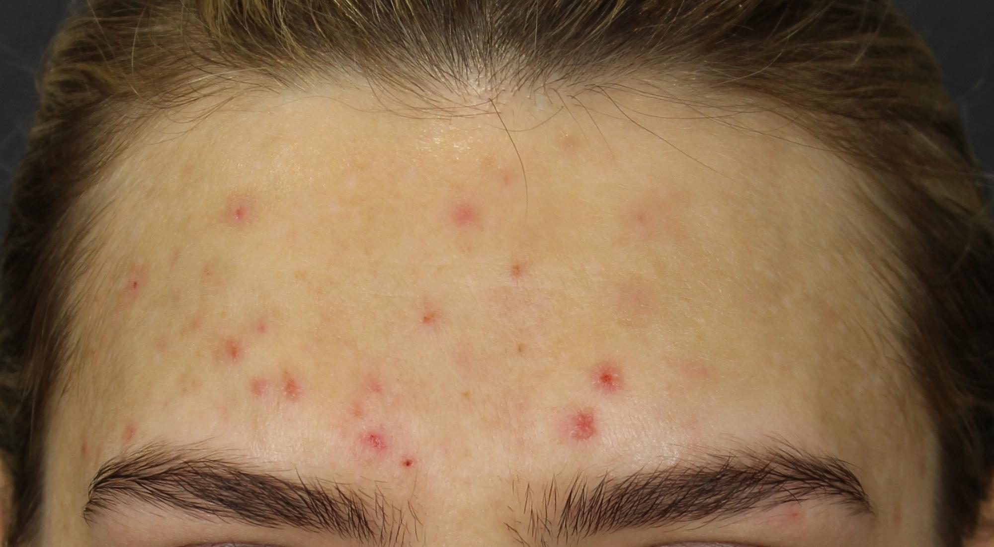 Active acne on forehead