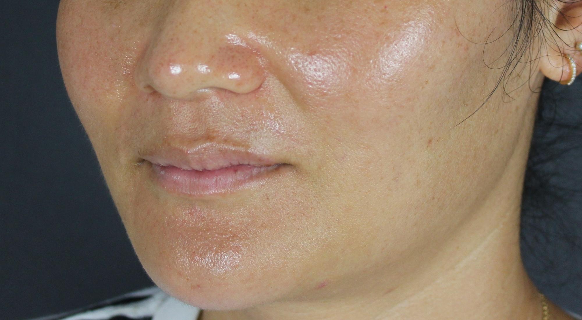 After treatment with Dr Natasha Cook for inflammatory acne