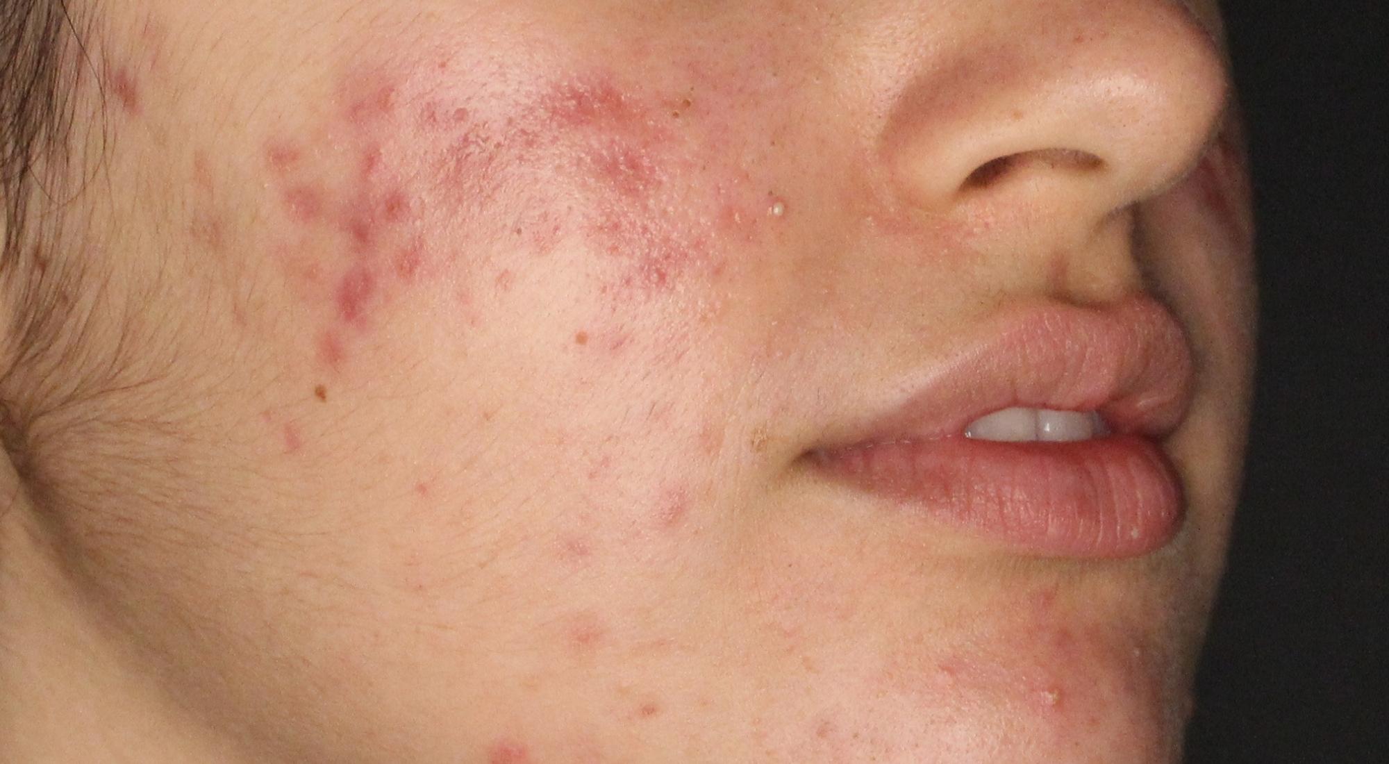 Before treatment for acne with Dr Natasha Cook