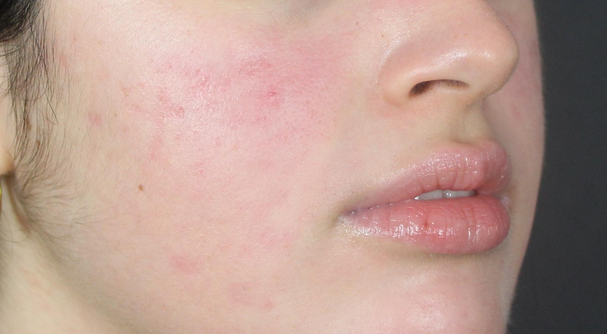 After acne treatment
