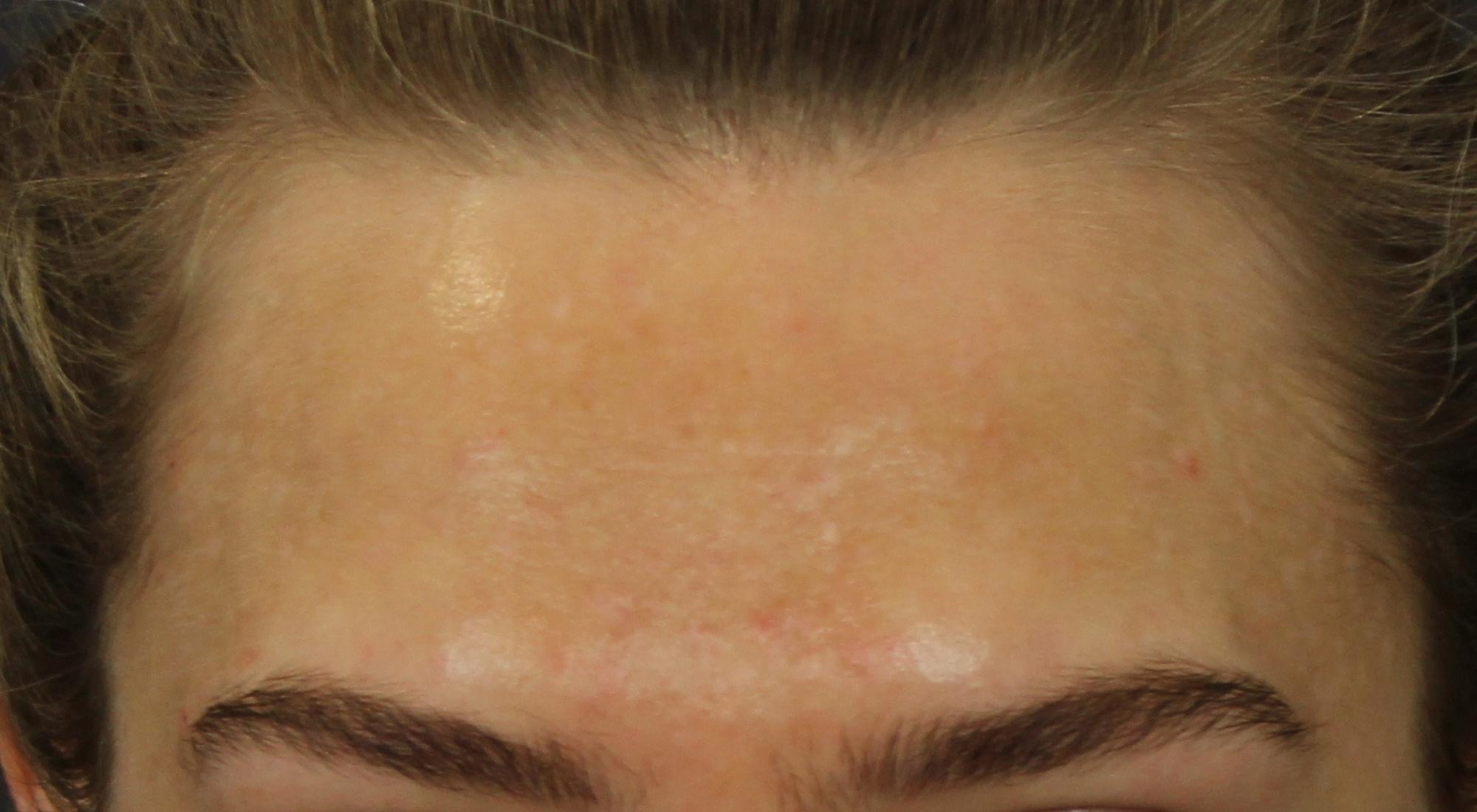 After treatment for inflammatory acne