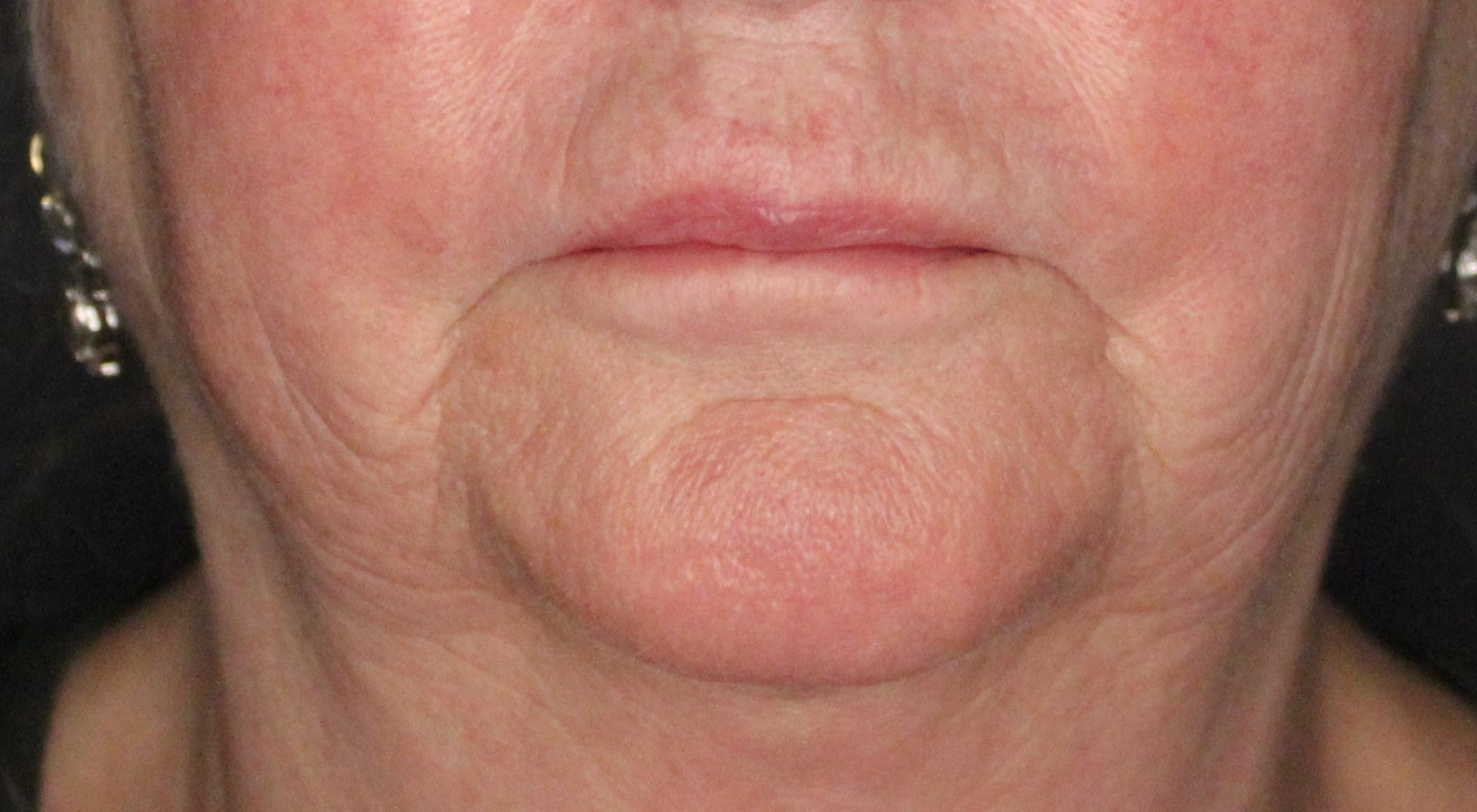 Loose and ageing skin can be tightened and firmed with a range of laser treatments