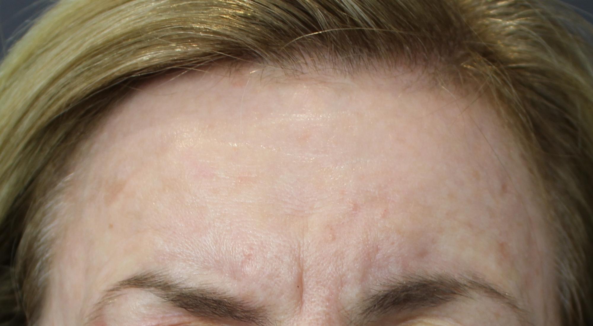 Before anti-wrinkle injections with Dr Natasha Cook for frown lines Botox