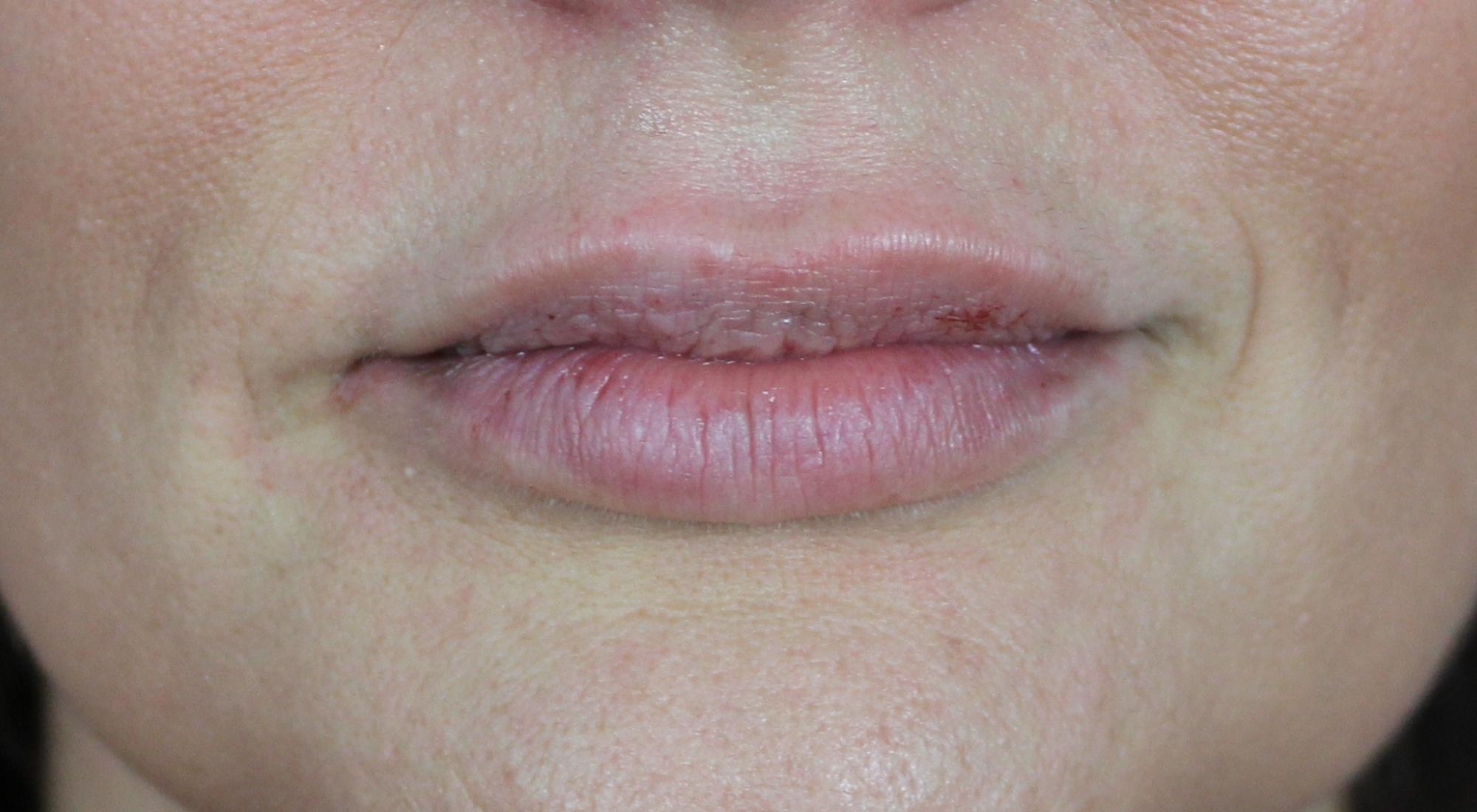 After lip filler with Dr Natasha Cook