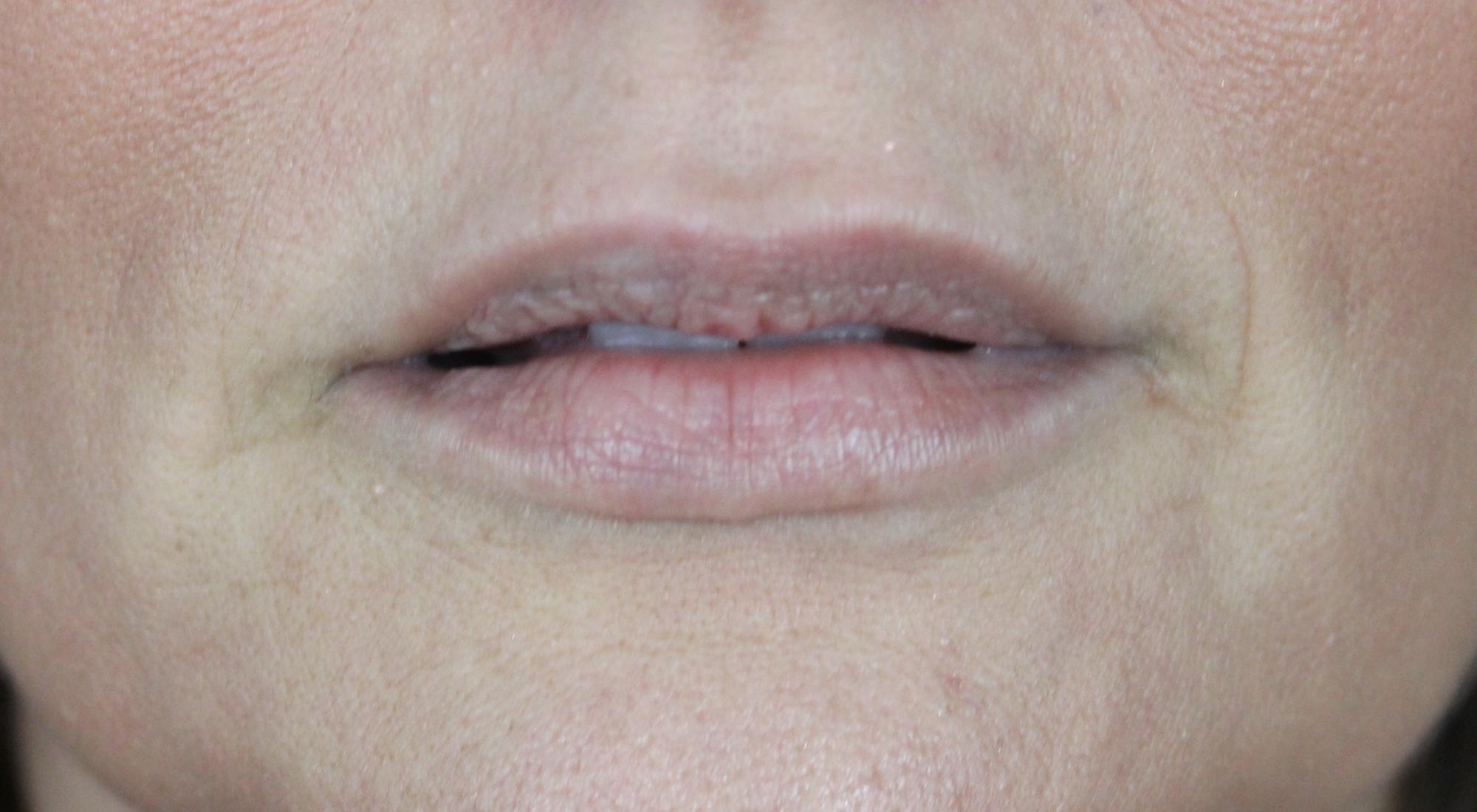 Before lip filler with Dr Natasha Cook