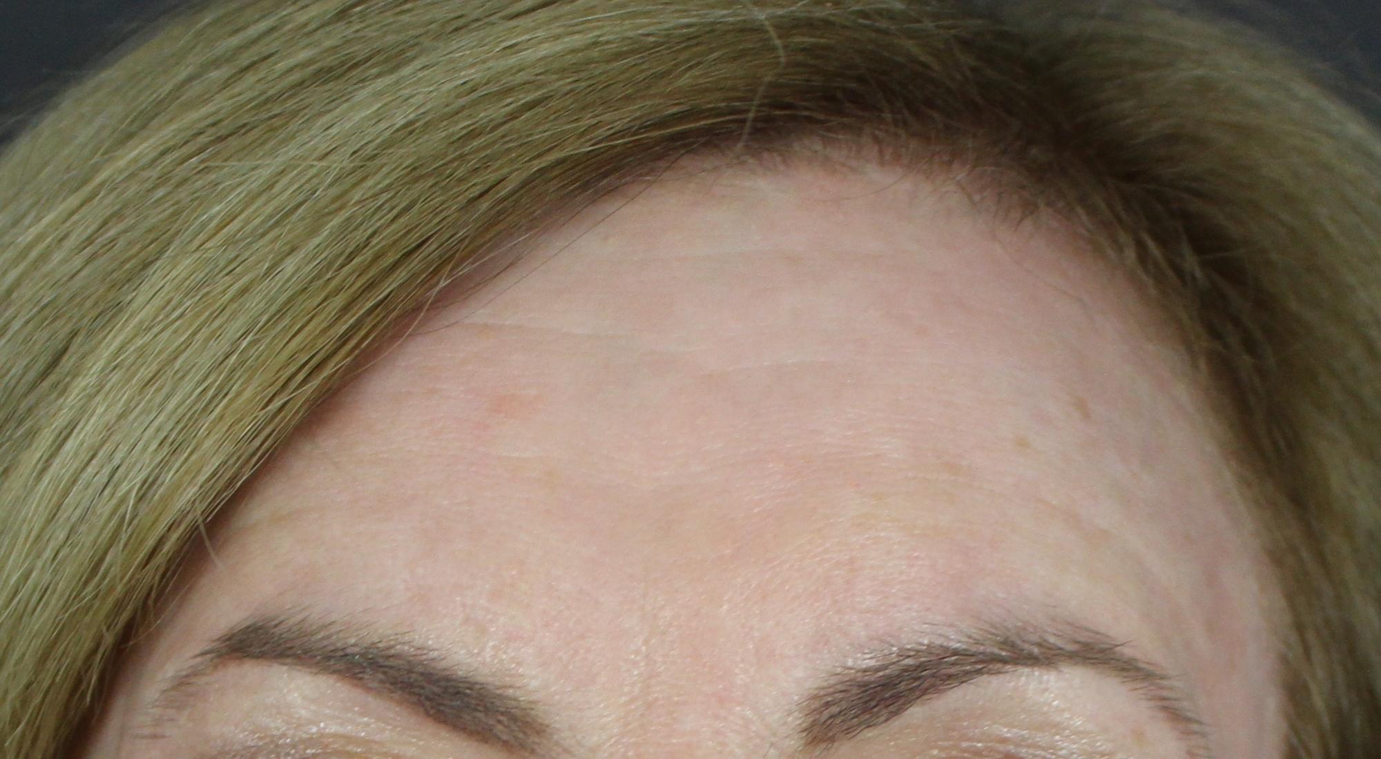 After, the treatment has smoothed the area between the eyes