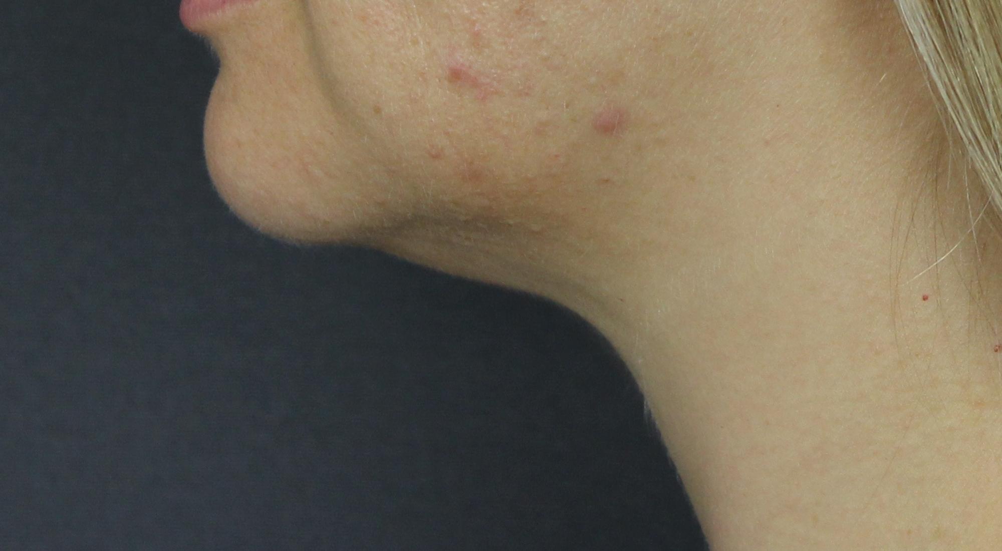 Before Belkyra fat dissolving injectables