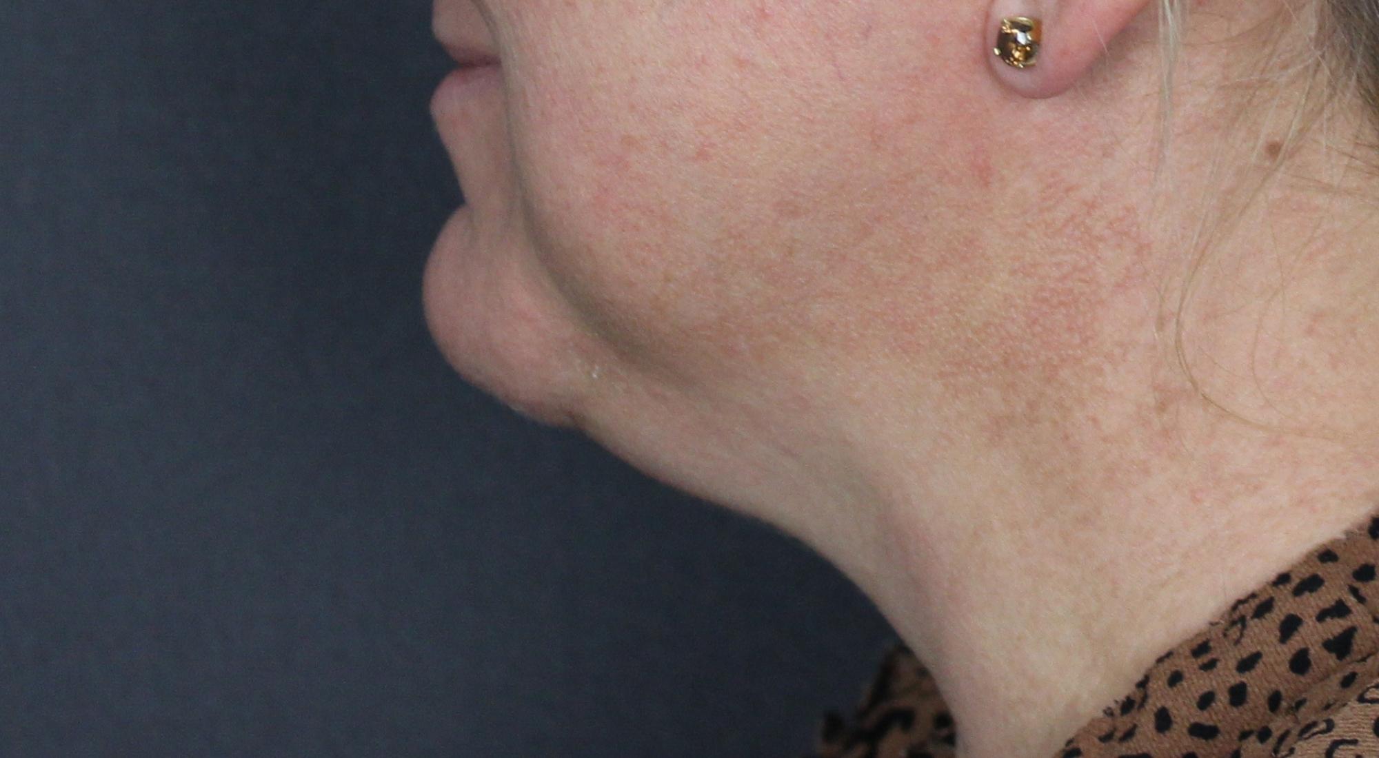 Before Belkyra fat dissolving injectables