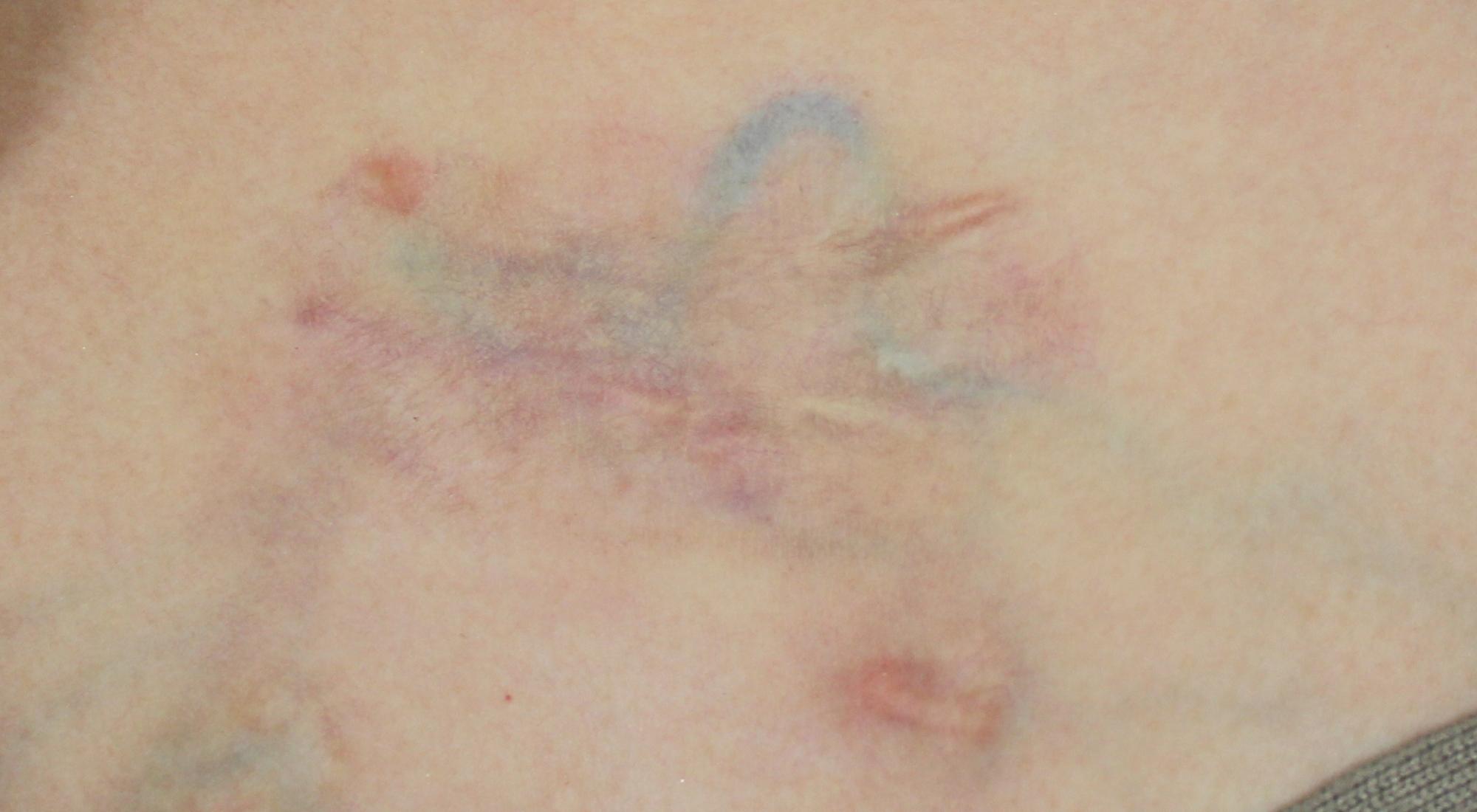 After treatment the keloid chest scar is noticeably improved and lighter