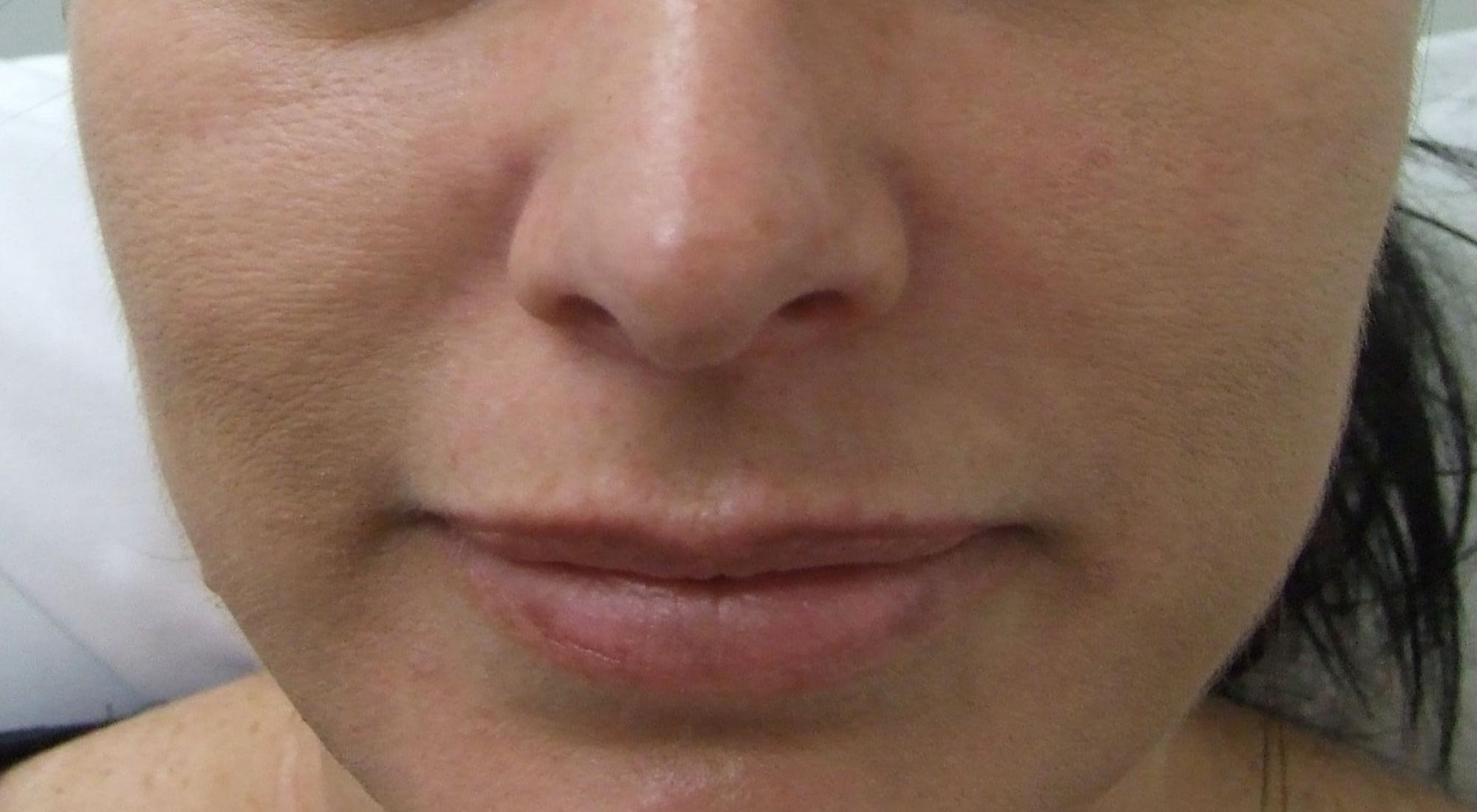 After treatment for facial pigmentation with Dr Natasha Cook