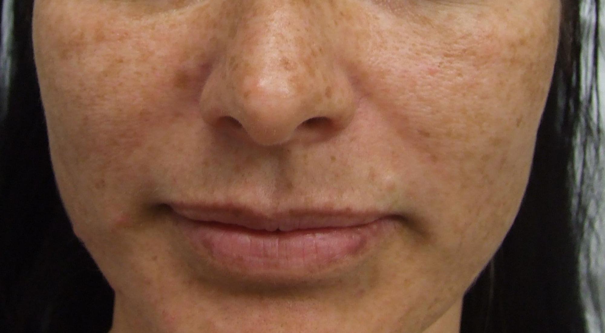 A young lady with facial pigmentation and freckles