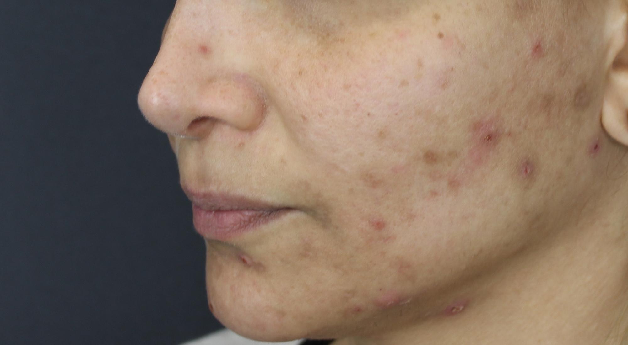 Post acne redness is another form of pigmentation that can be treated by Dr nNatasha Cook