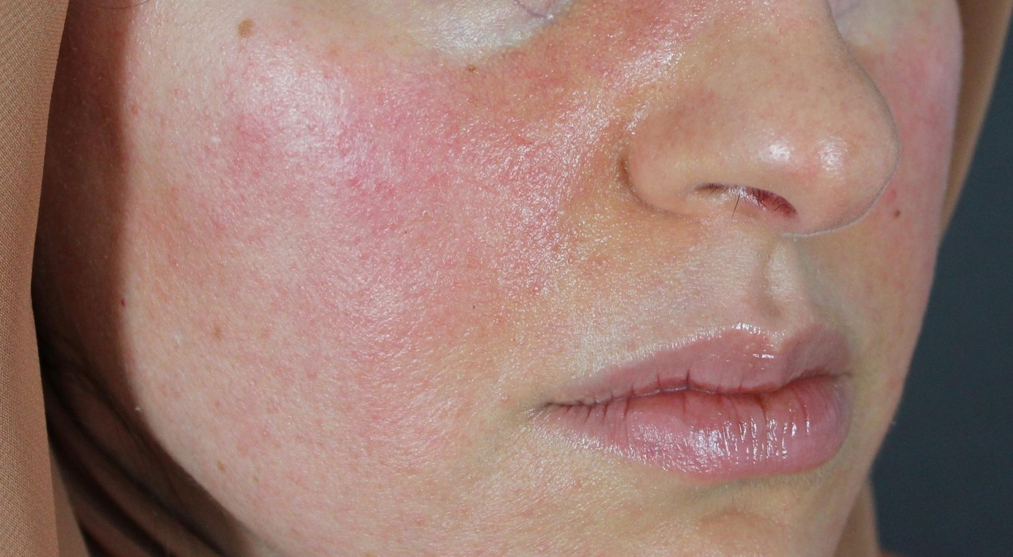 Evening out skin tone and sensitivity