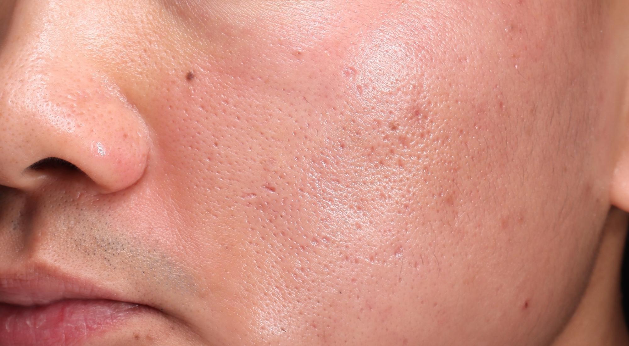Before Alma Hybrid laser for acne scars on men with skin type