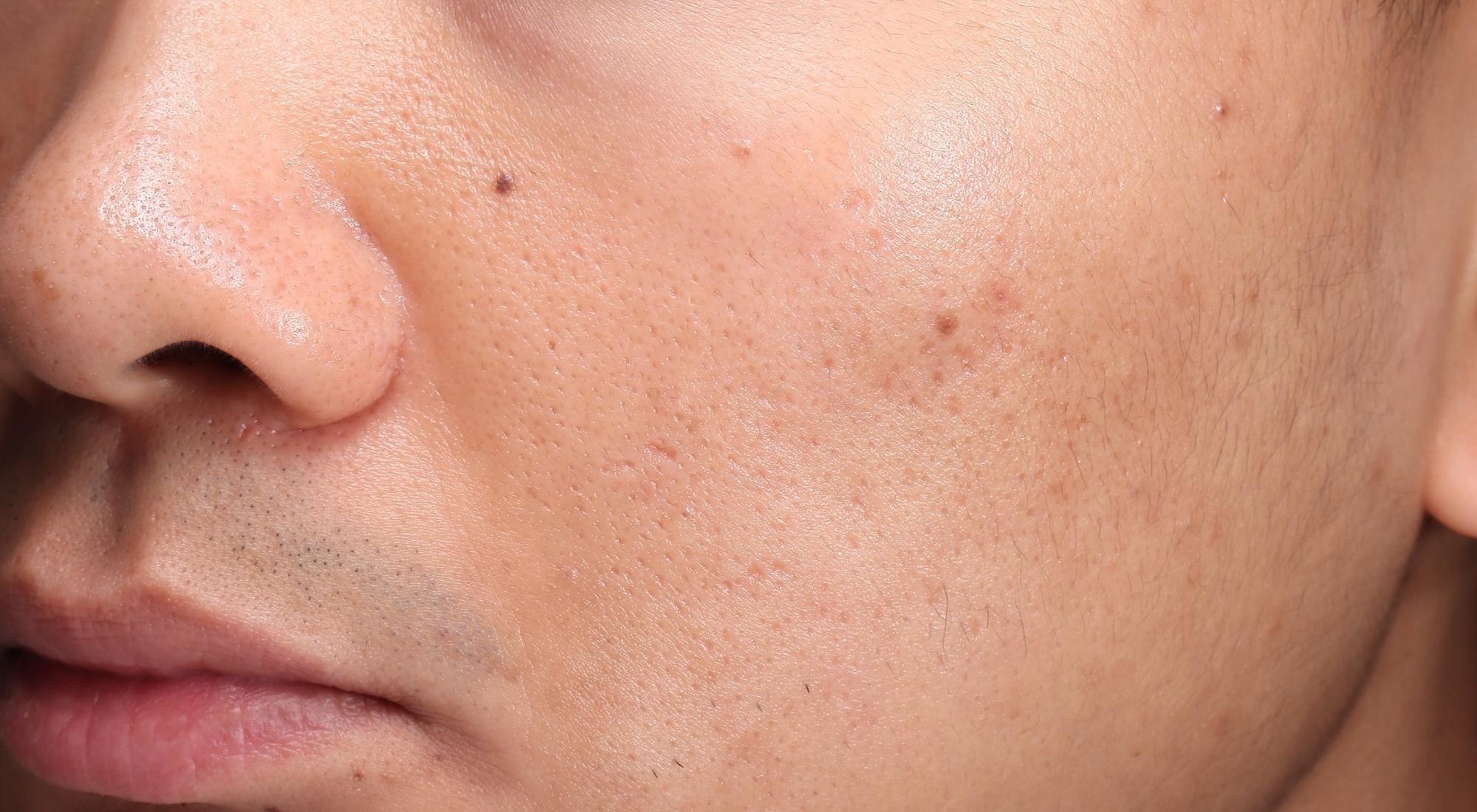 After Alma Hybrid laser for acne scars on men with skin type