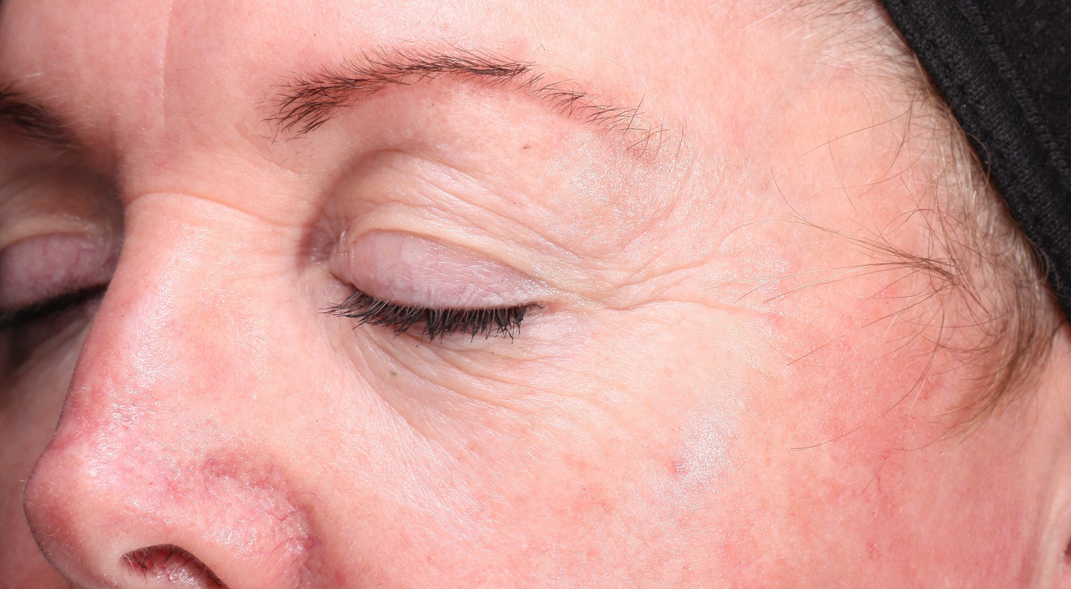 Periorbital wrinkles before Alma Hybrid laser. Crows feet wrinkles, fine lines, ageing