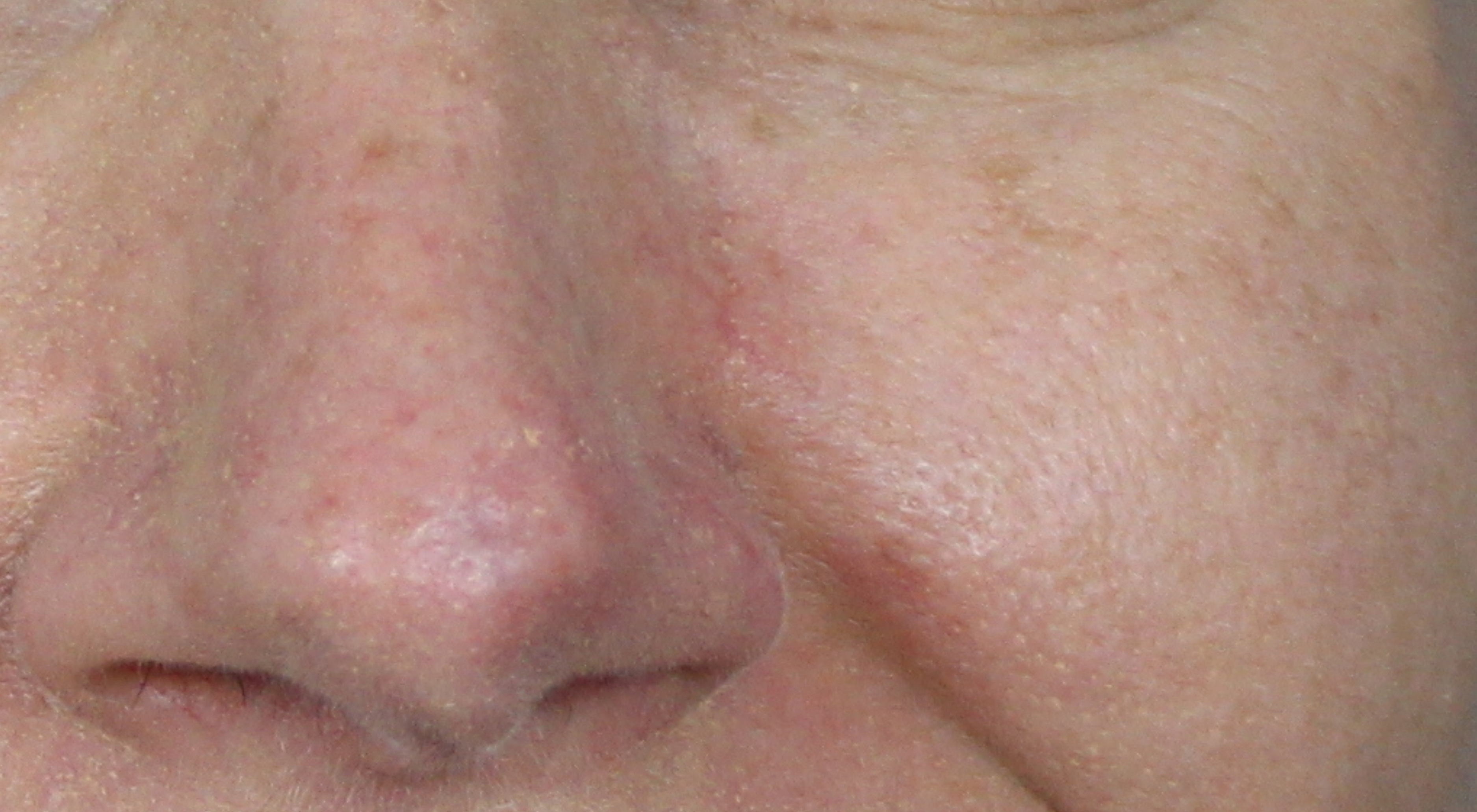 After Surgical scar revision in Sydney Dermatologist Dr Natasha Cook Alma Hybrid CO2 for scar improvement post mohs surgery face