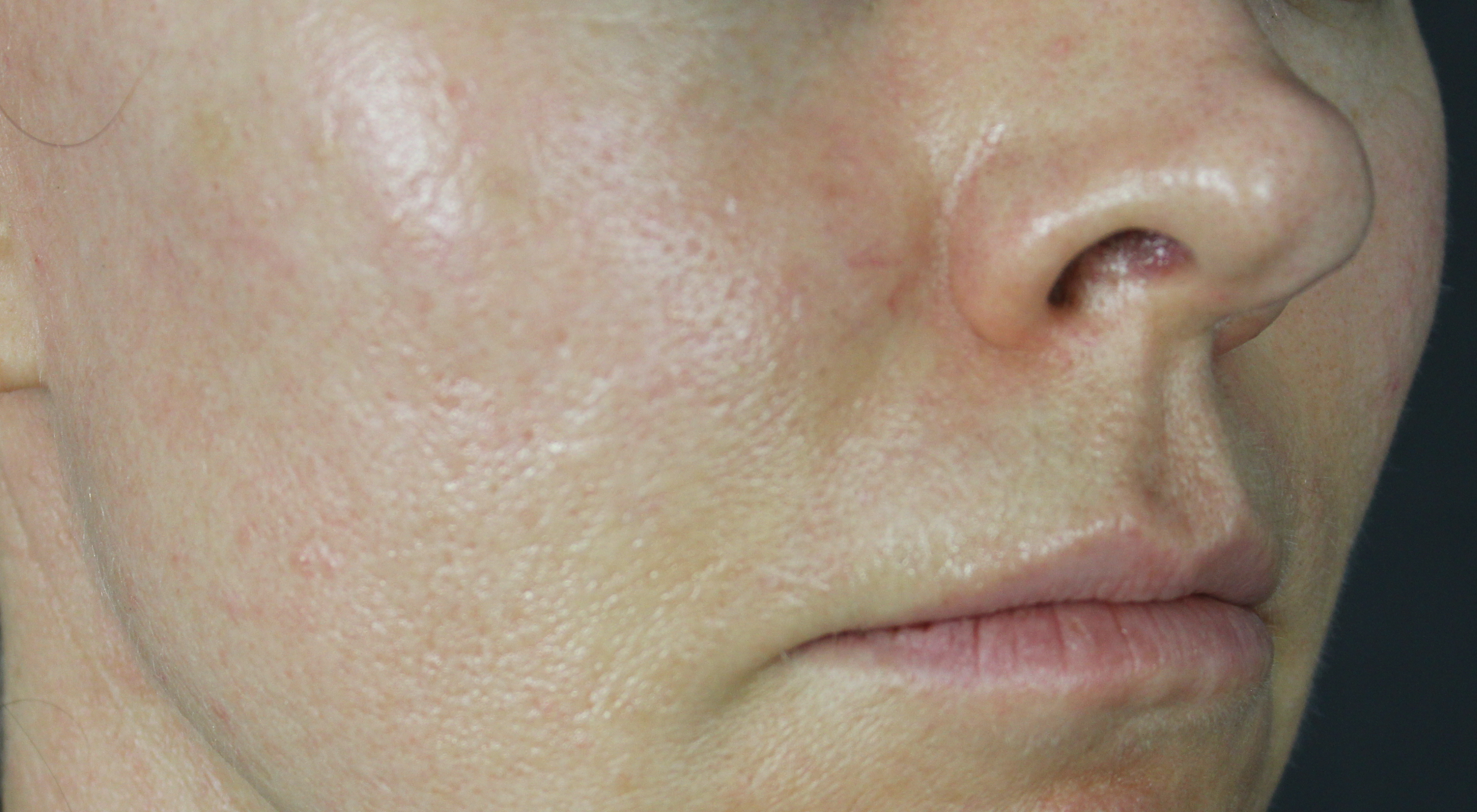 Before Alma Hybrid fractionated co2 laser for acne scars in Sydney Australia dermatologist dr Natasha cook Darlinghurst