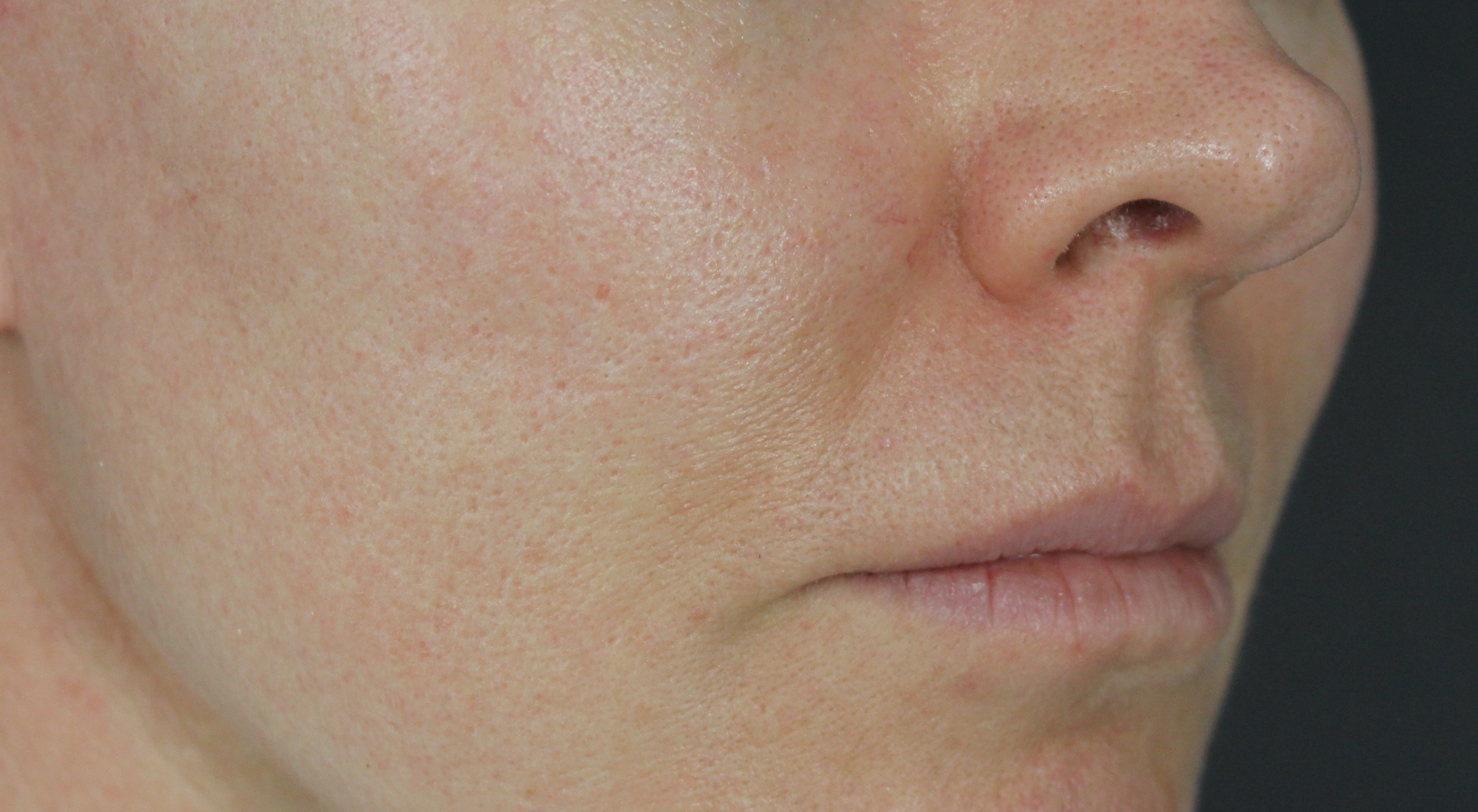 Before Alma Hybrid fractionated co2 laser for acne scars in Sydney Australia dermatologist dr Natasha cook Darlinghurst