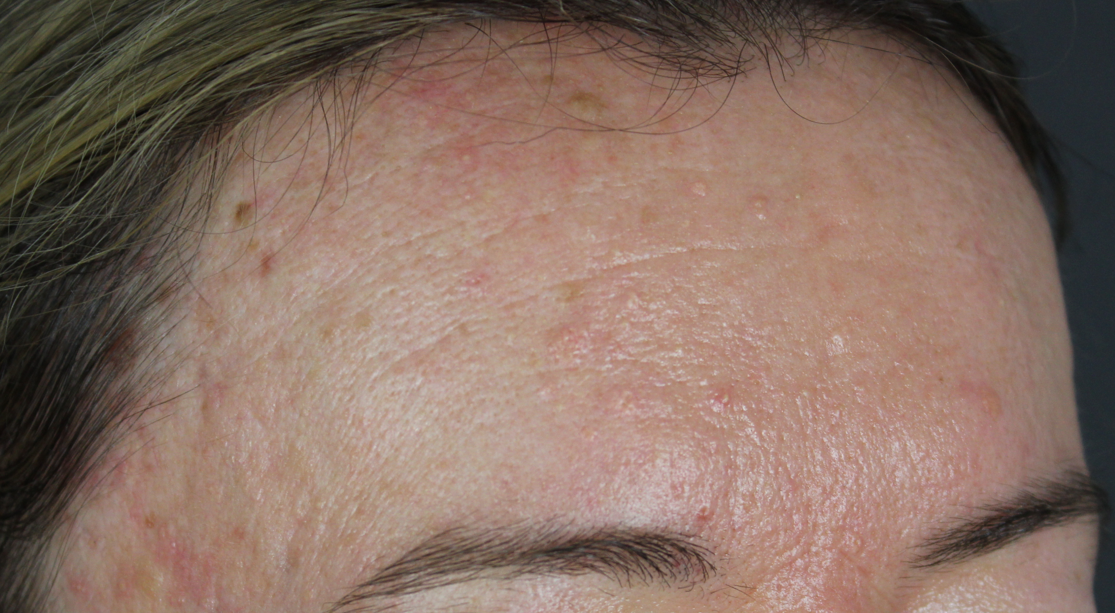 Before Alma Hybrid fractionated co2 laser for acne scars in Sydney Australia dermatologist dr Natasha cook Darlinghurst