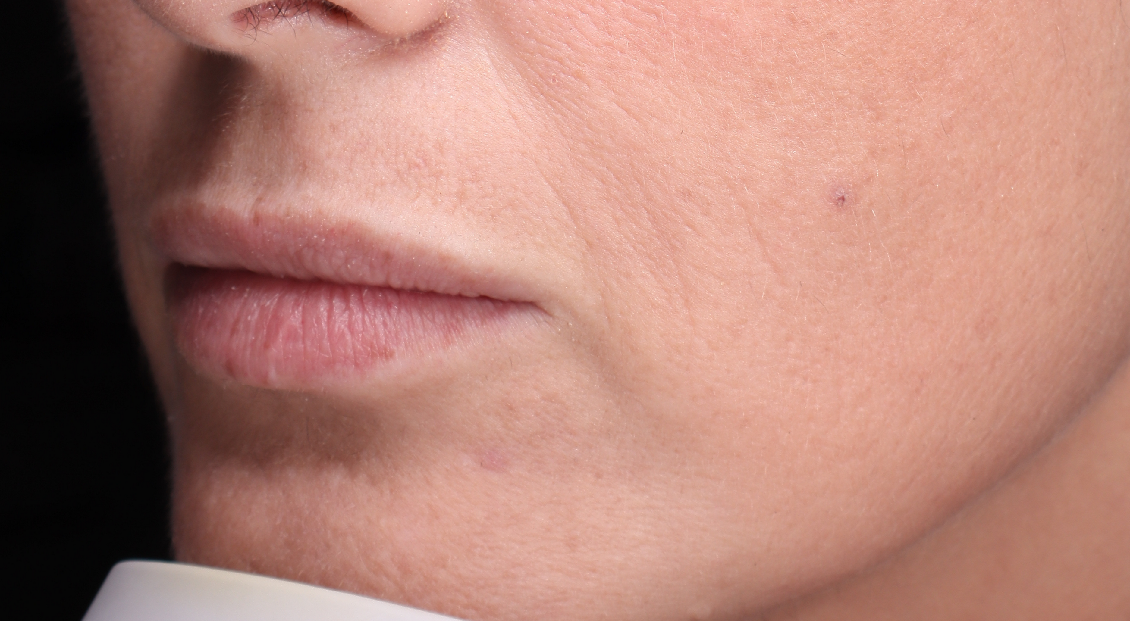 Before lip filler natural lips in Sydney Darlinghurst dermatology dr Natasha cook