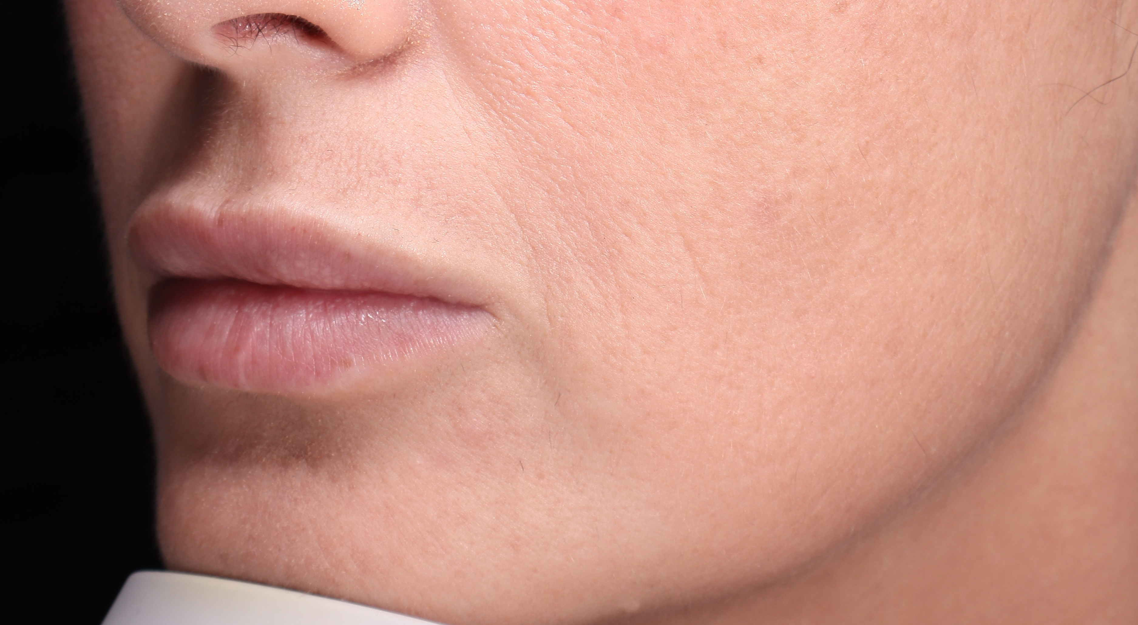 After lip filler natural lips in Sydney Darlinghurst dermatology dr Natasha cook