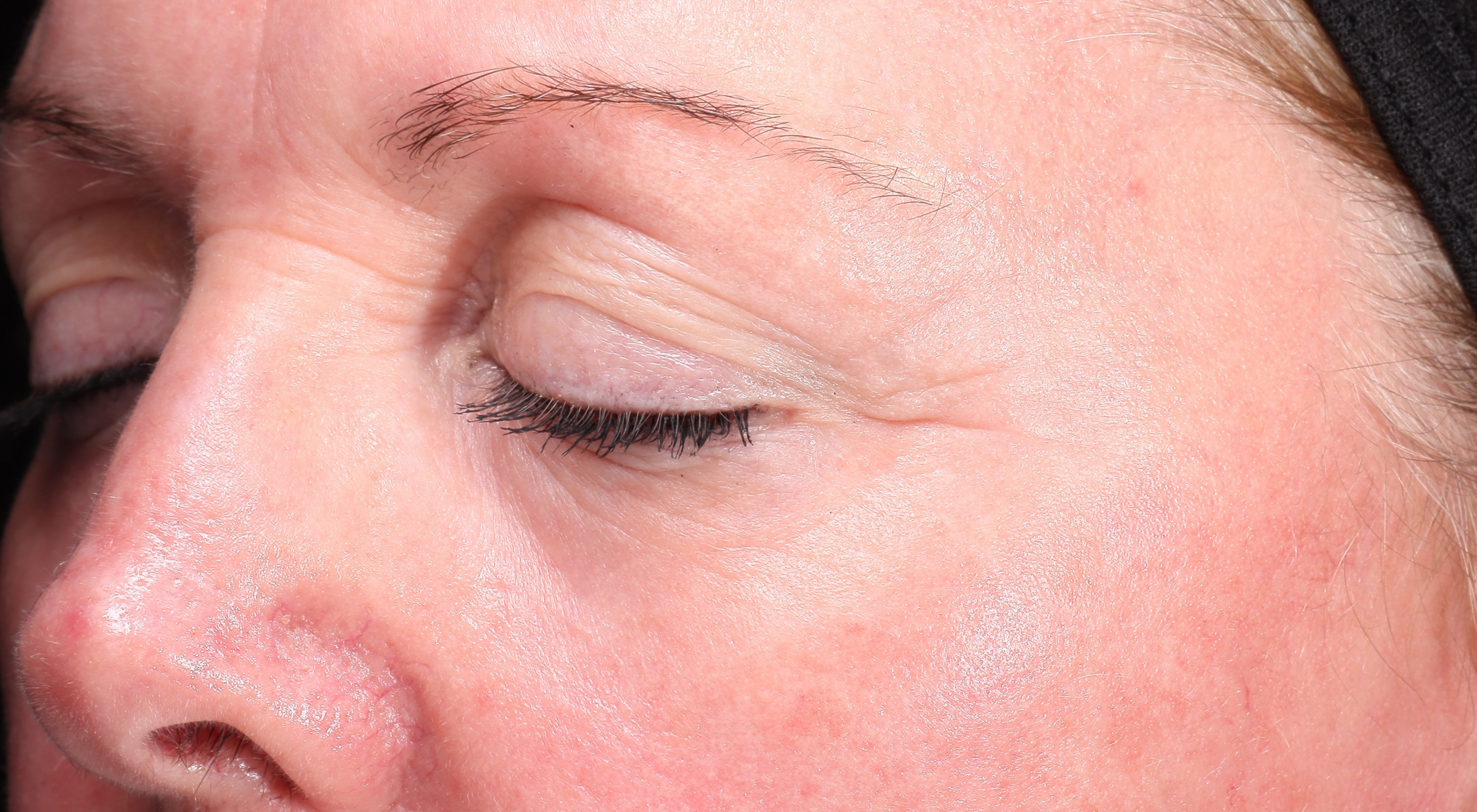 After Antiageing laser treatment Dr Natasha Cook Darlinghurst Dermatology. Rejuvenated under eyes periorbital area. Alma Hybrid CO2 Laser in Sydney, Darlinghurst. The Face Bar by dr.NC