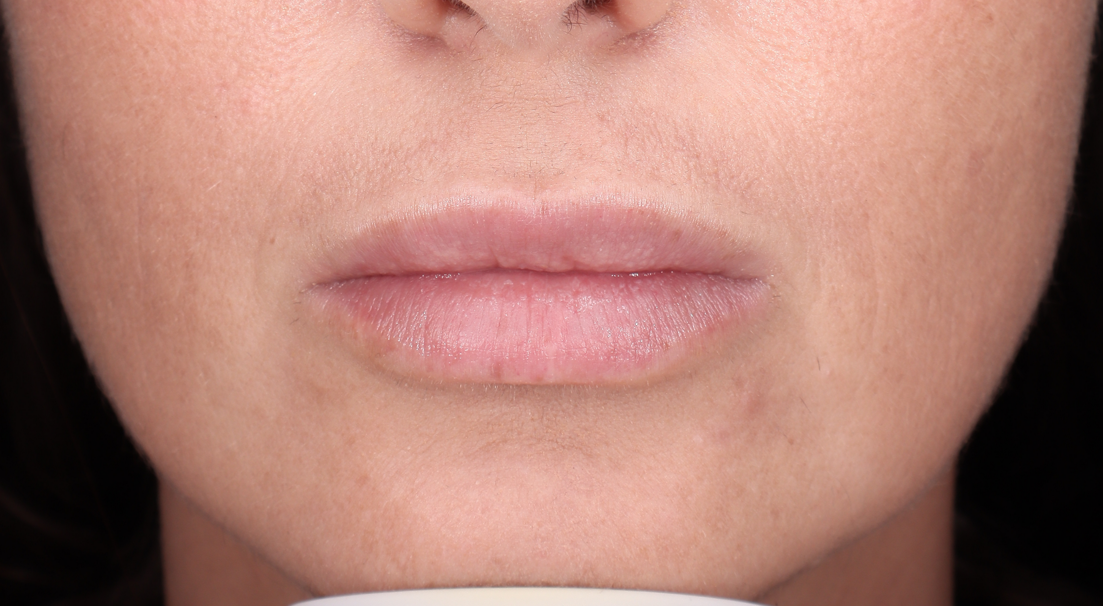 After lip filler natural lips in Sydney Darlinghurst dermatology dr Natasha cook
