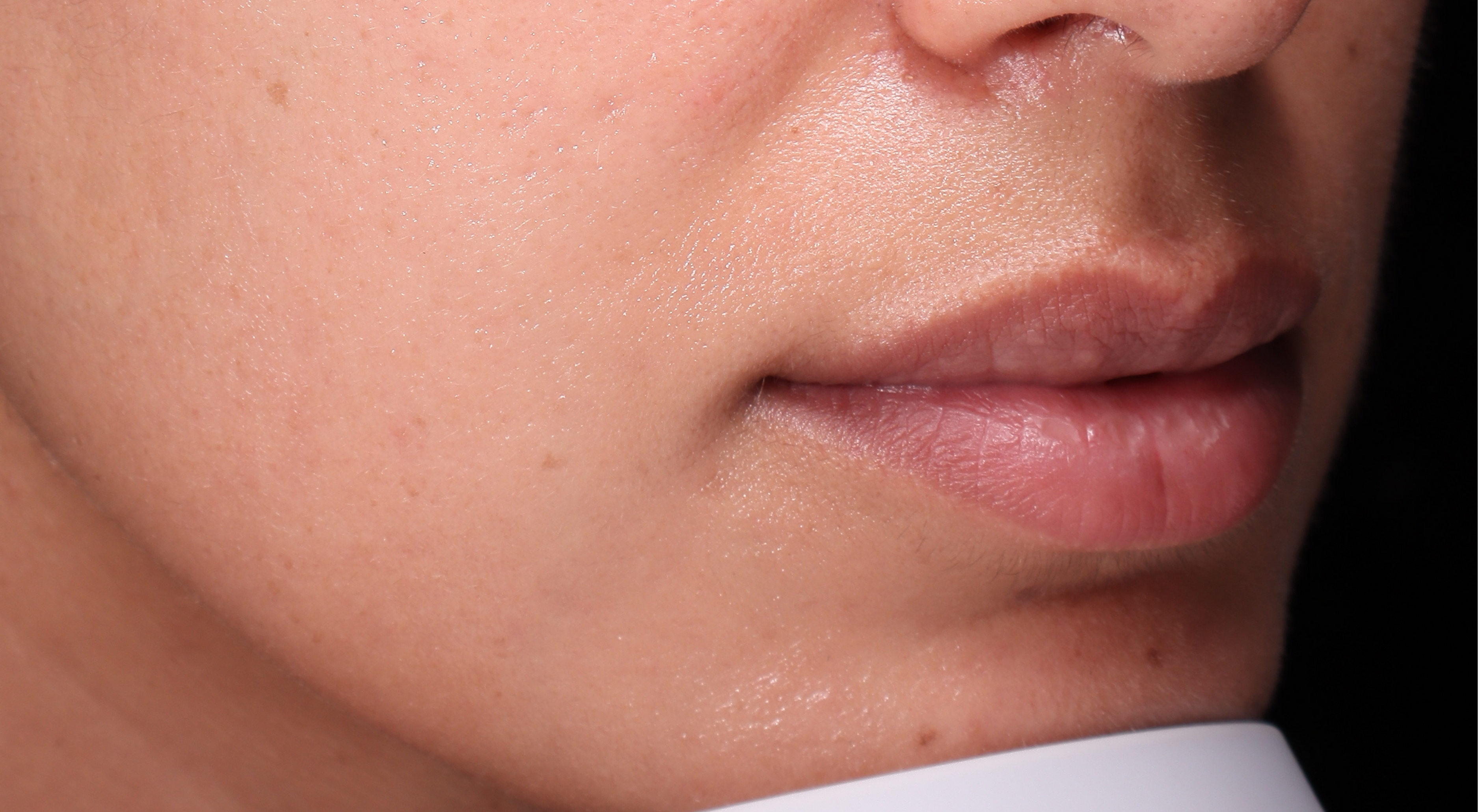 Before lip filler natural lips in Sydney Darlinghurst dermatology dr Natasha cook