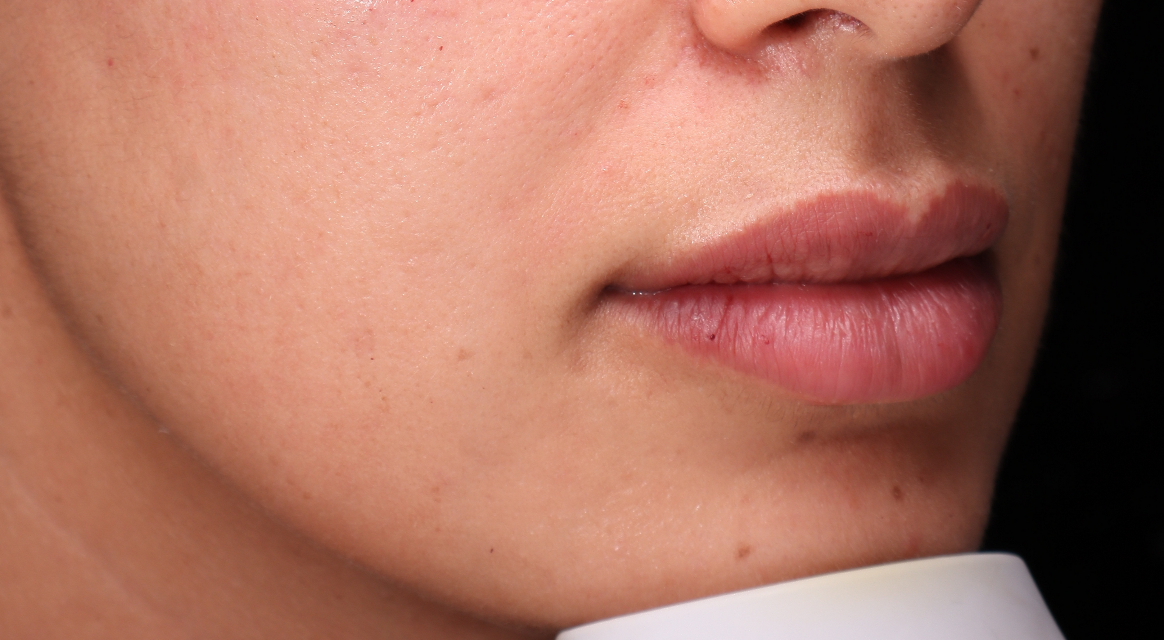 After lip filler natural lips in Sydney Darlinghurst dermatology dr Natasha cook